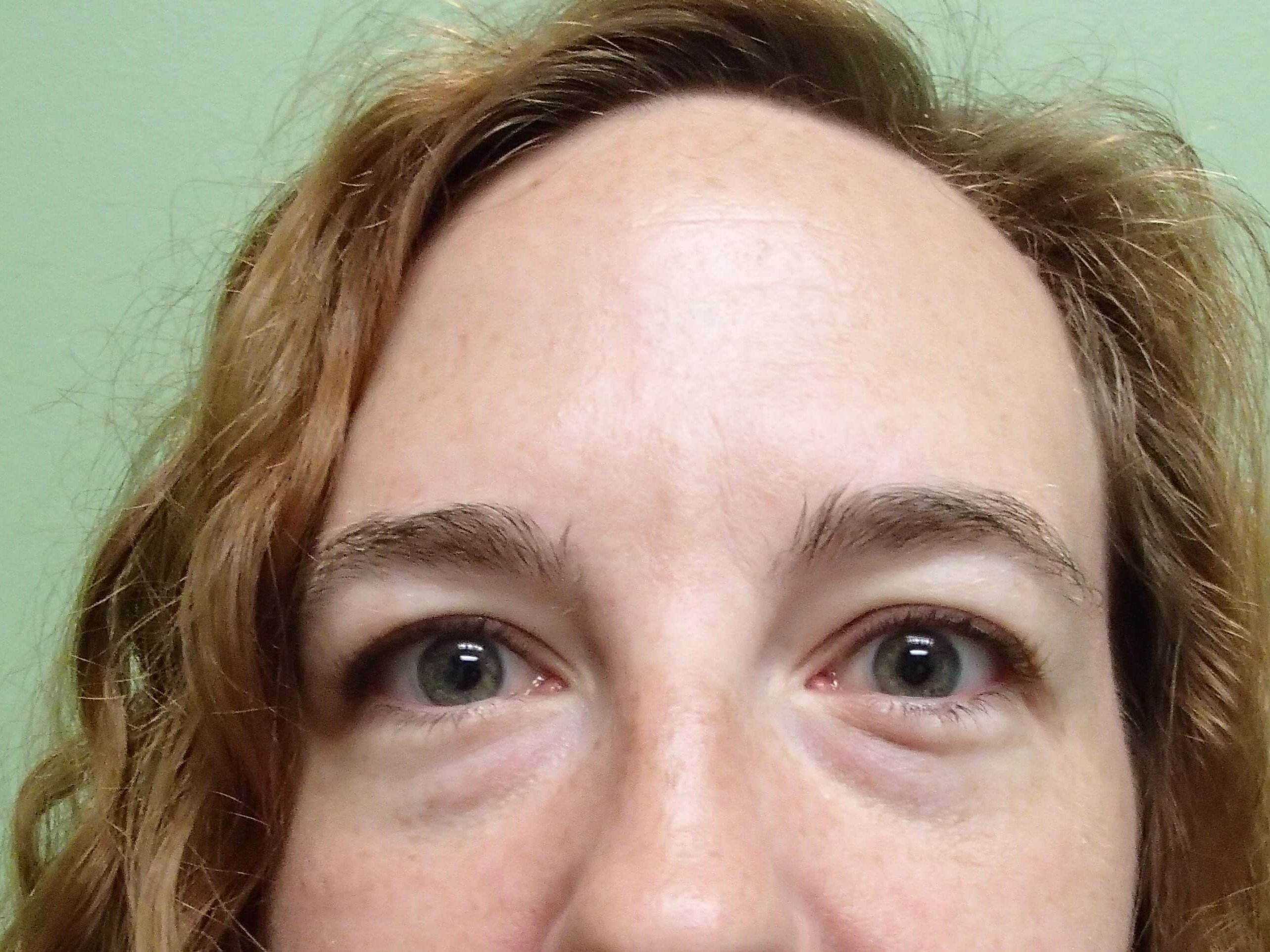 Browlift w/ Eyelid Lift Before