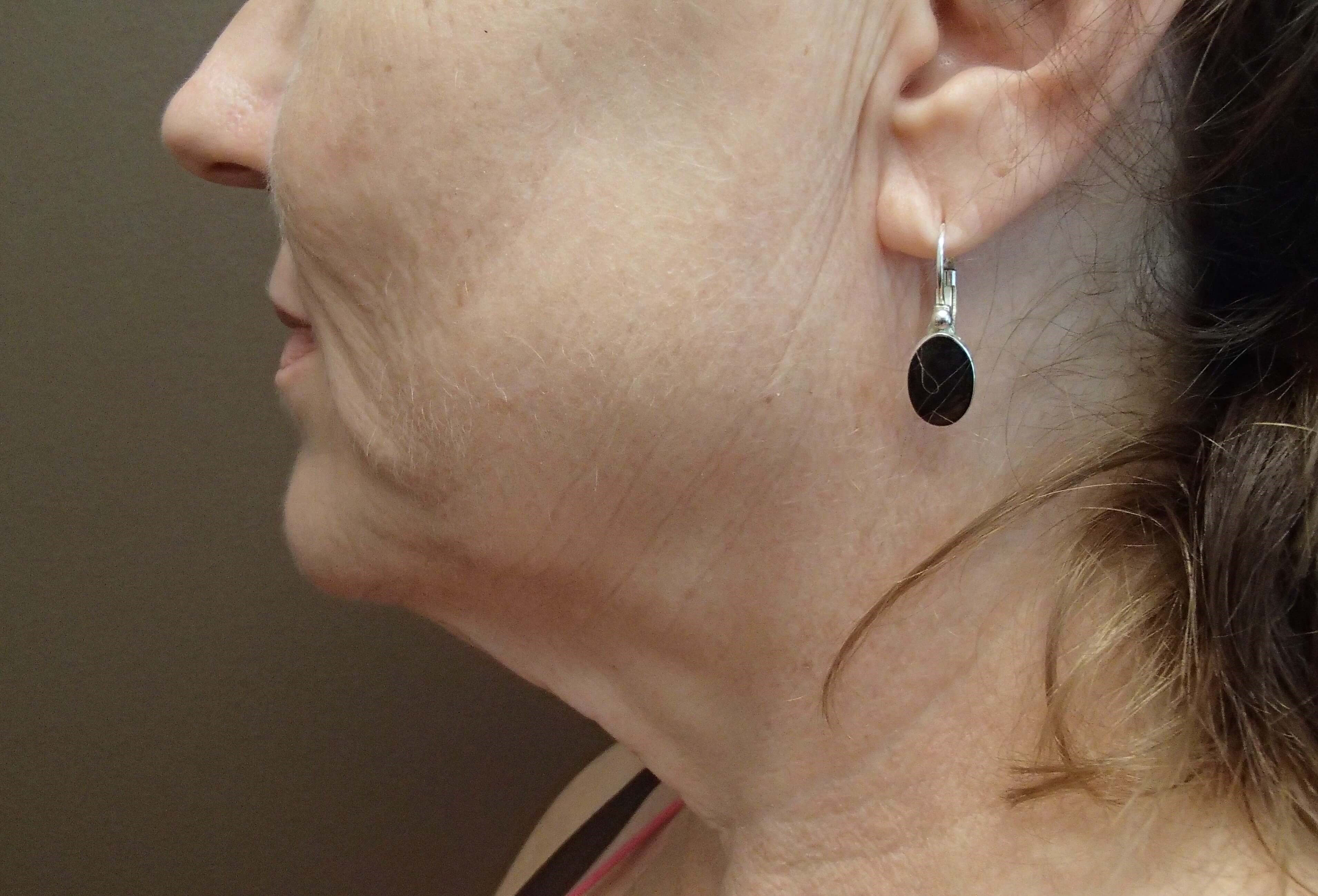 Facelift and Necklift Before