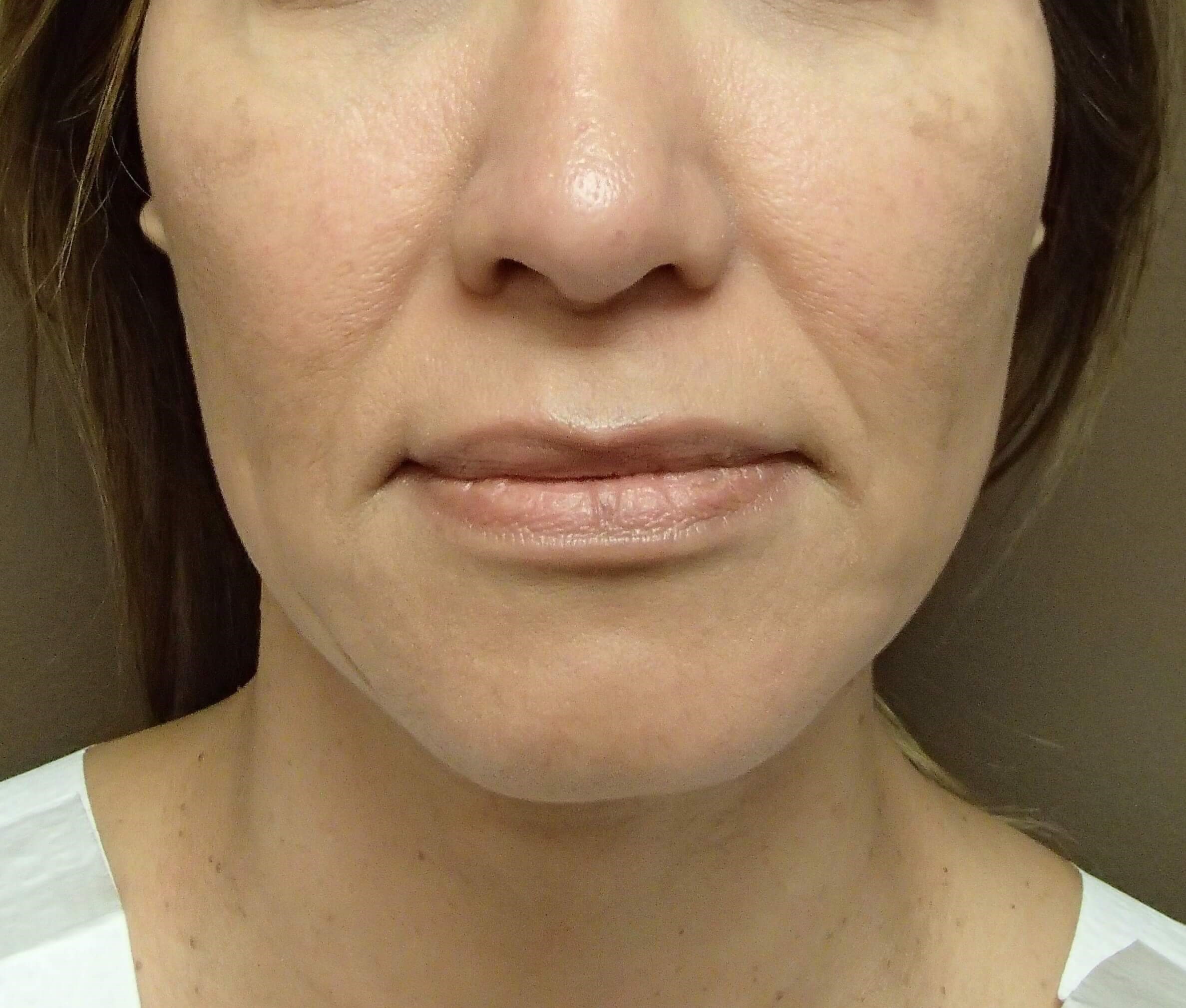 Facelift Before