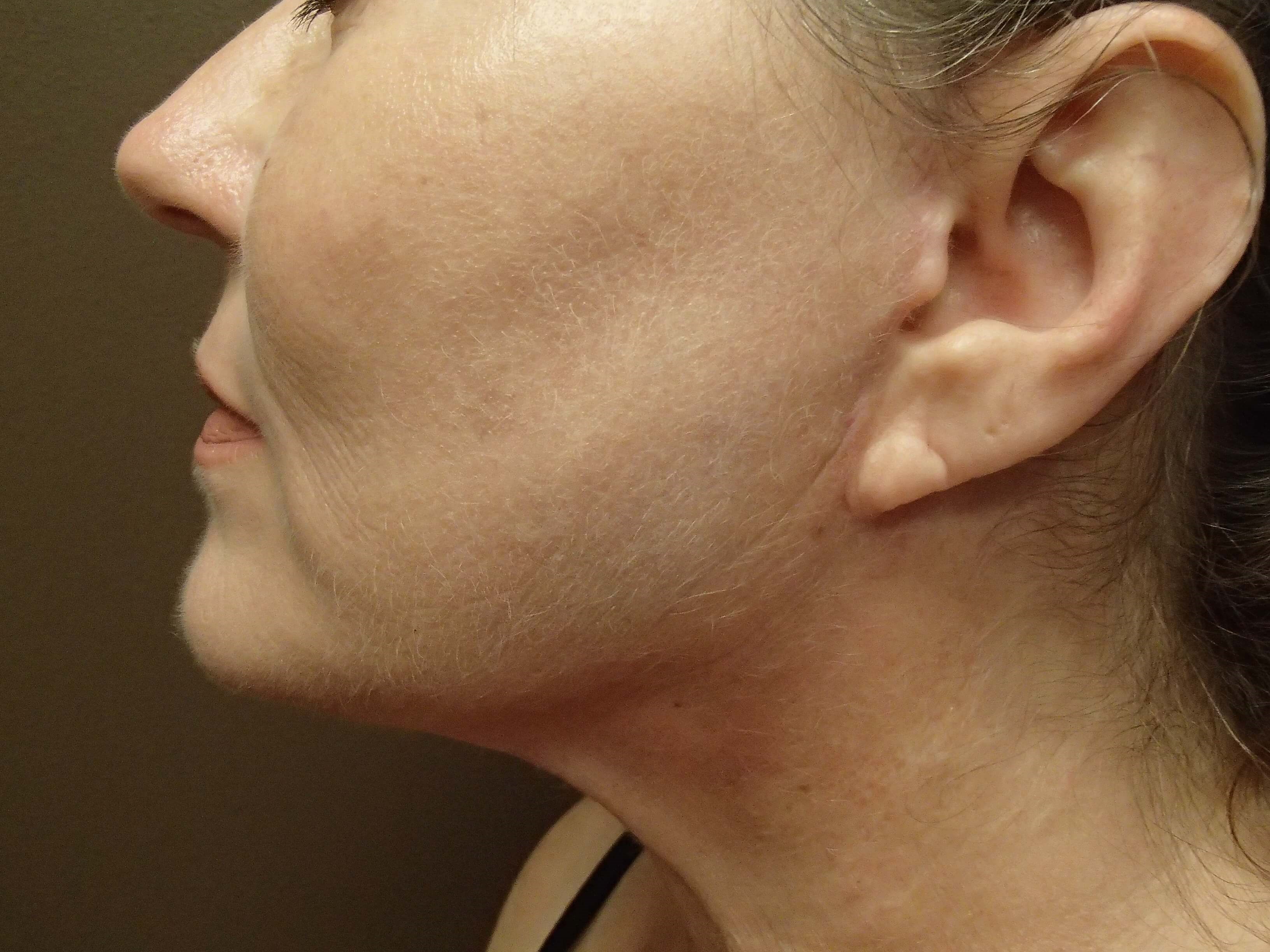 Facelift and Necklift After