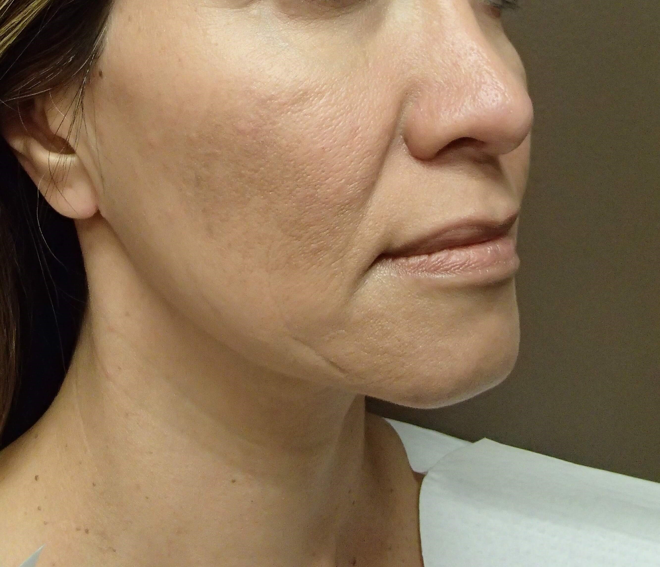 Facelift Before
