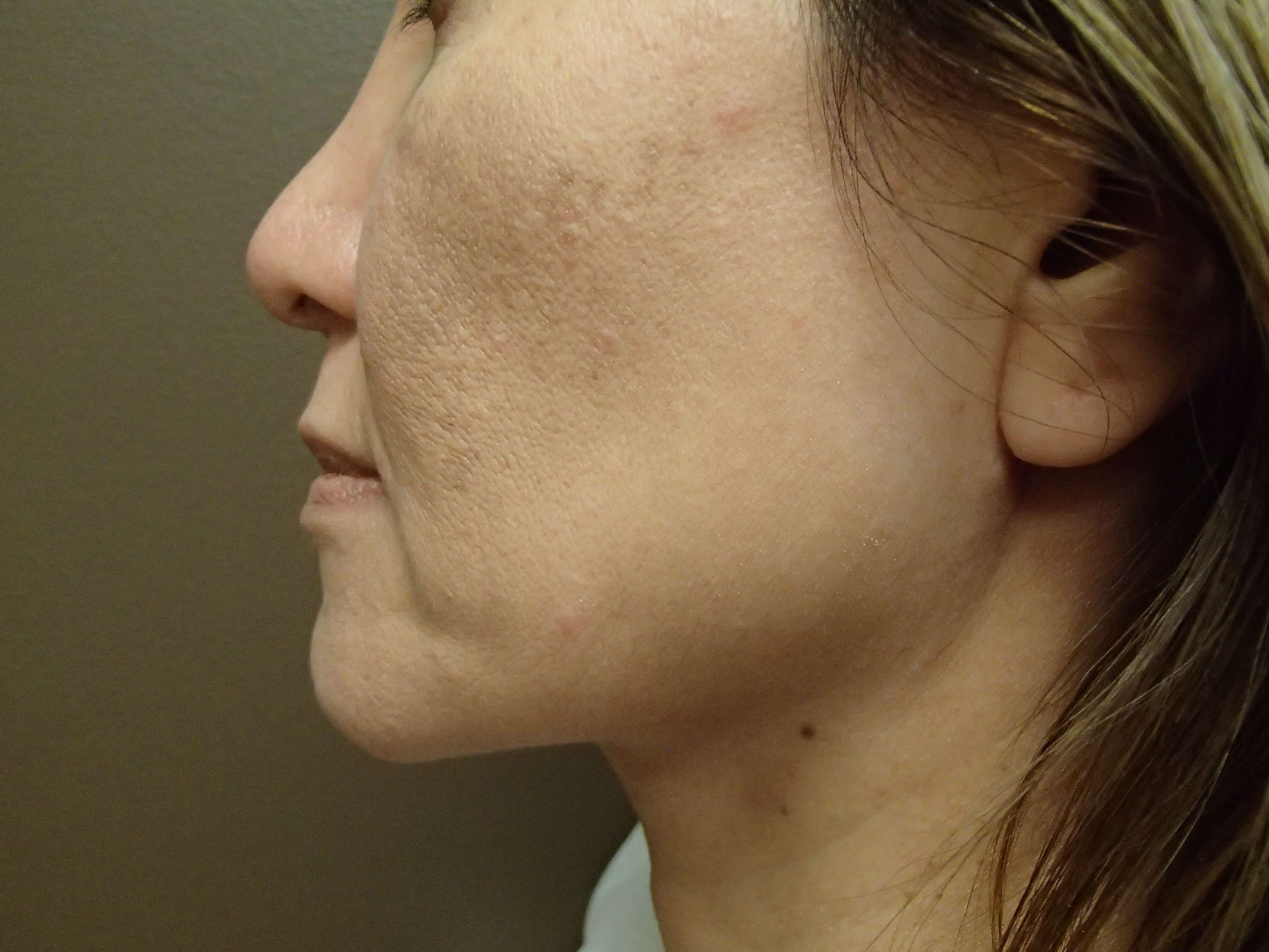 Facelift Before