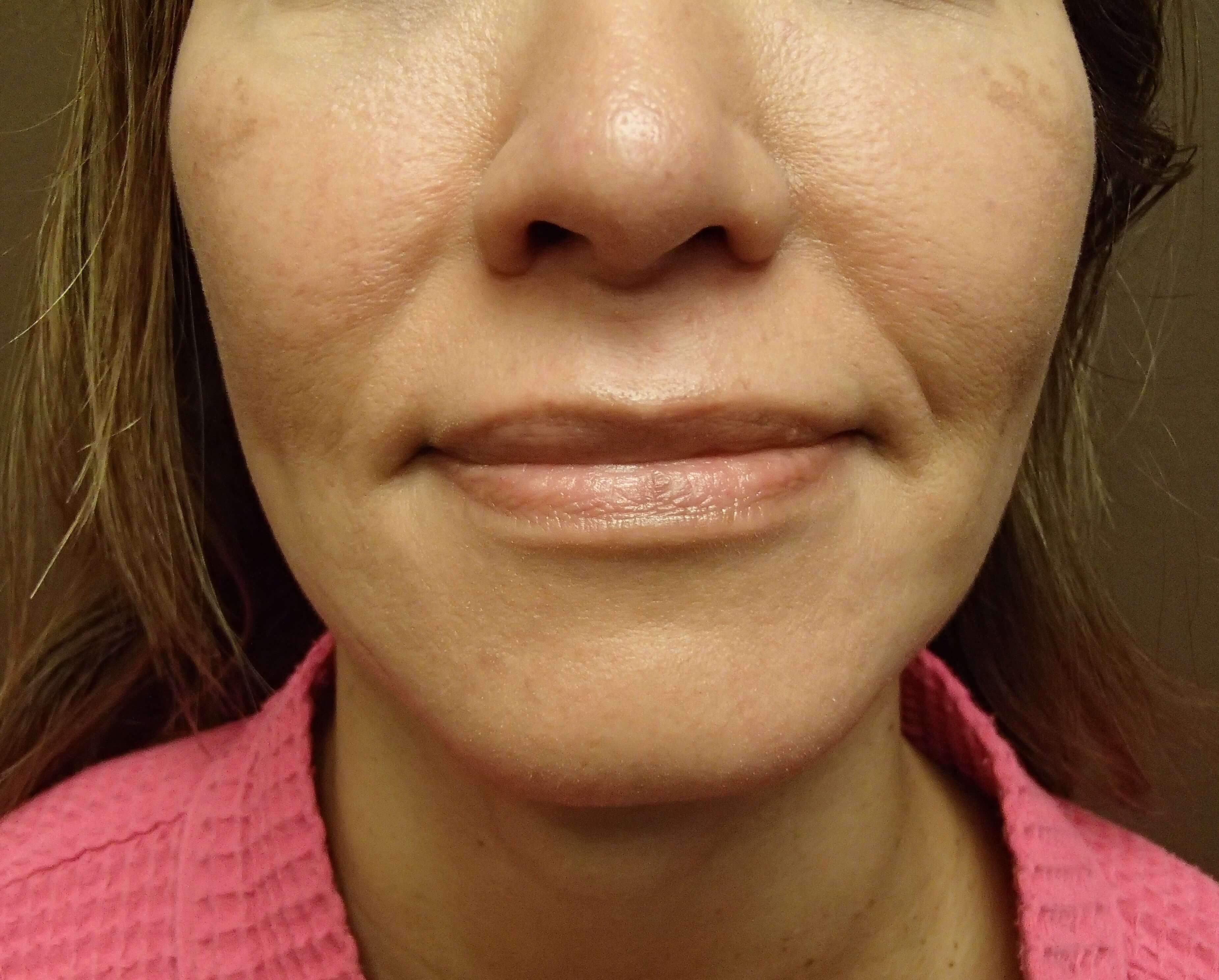 Facelift After
