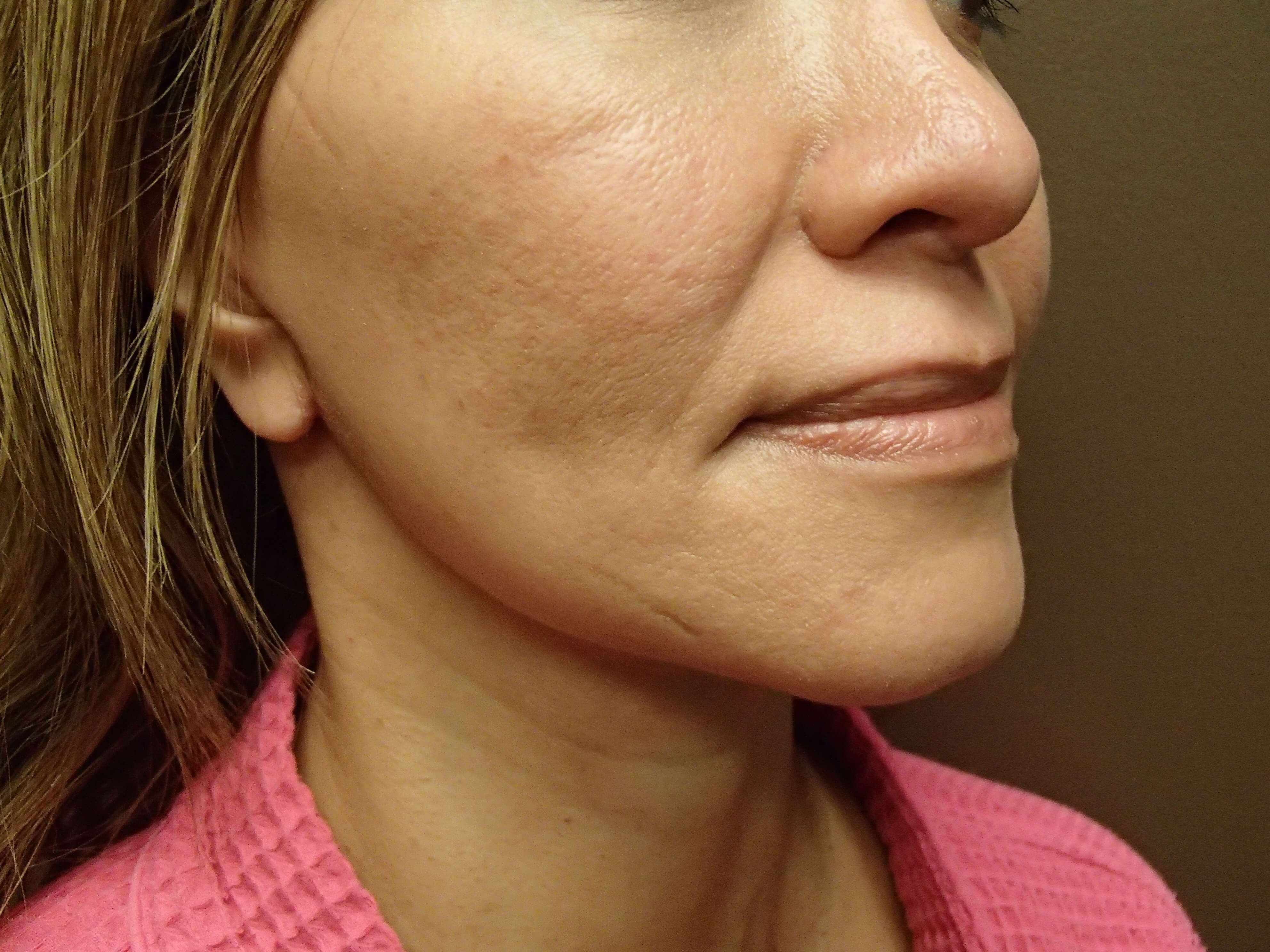 Facelift After