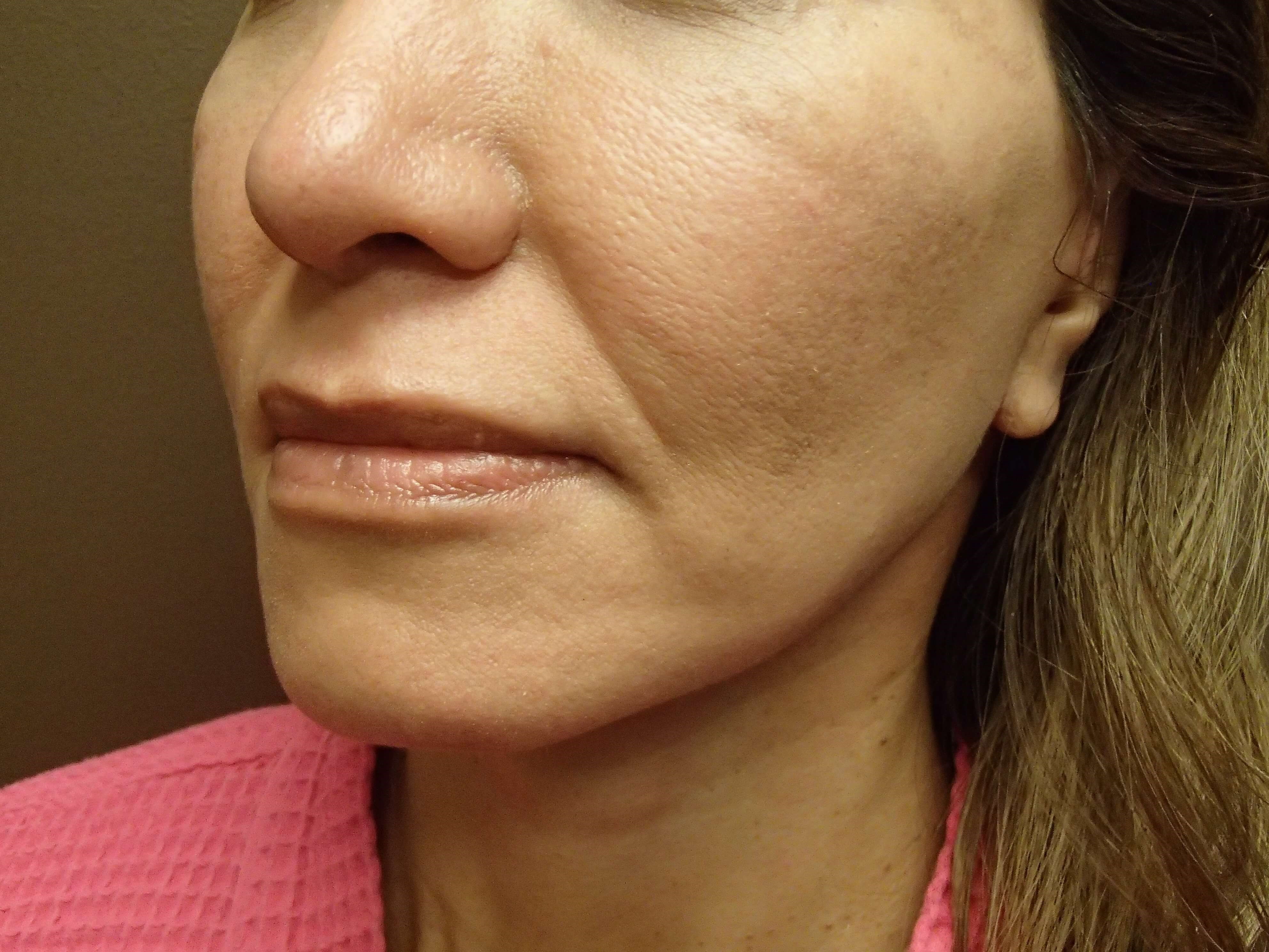 Facelift After