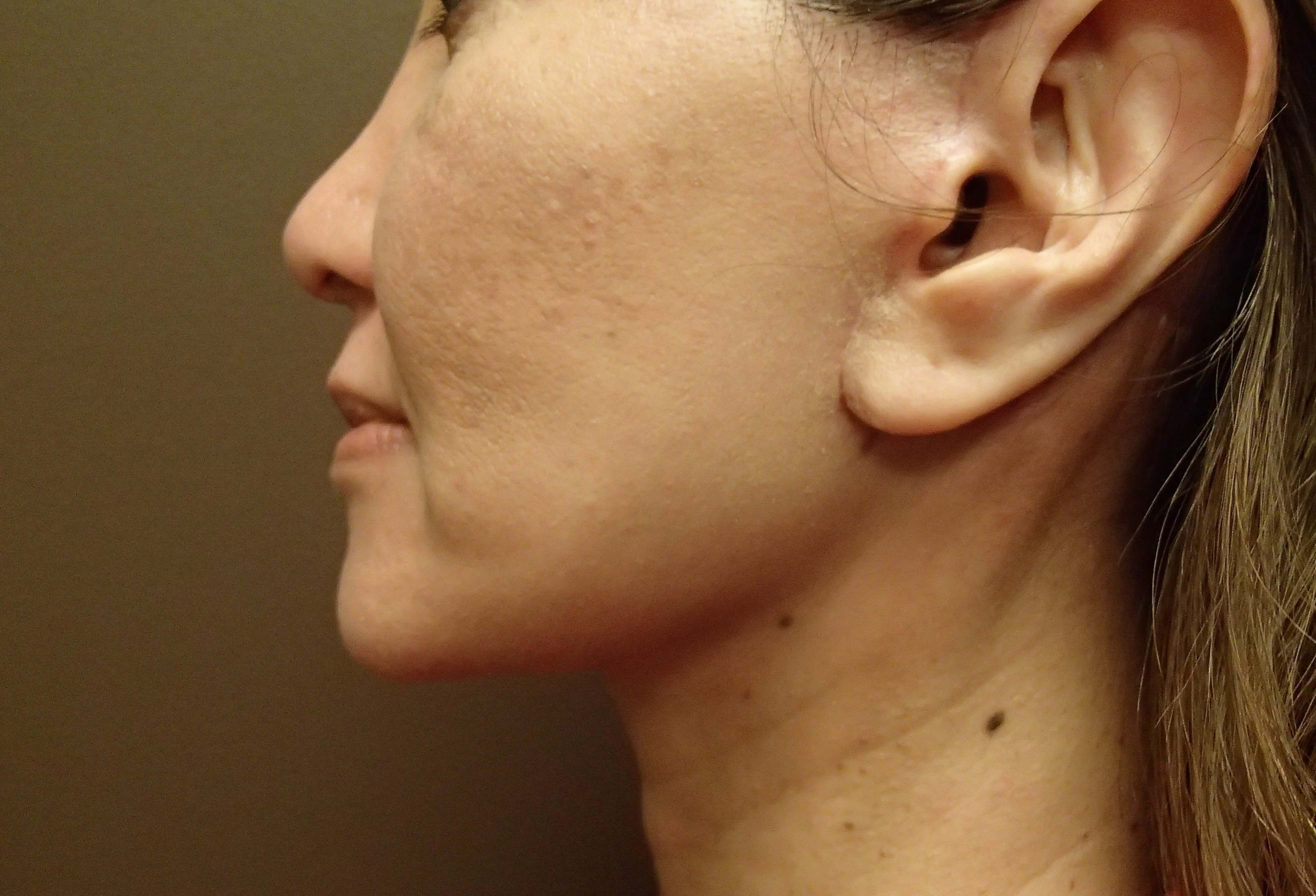Facelift After