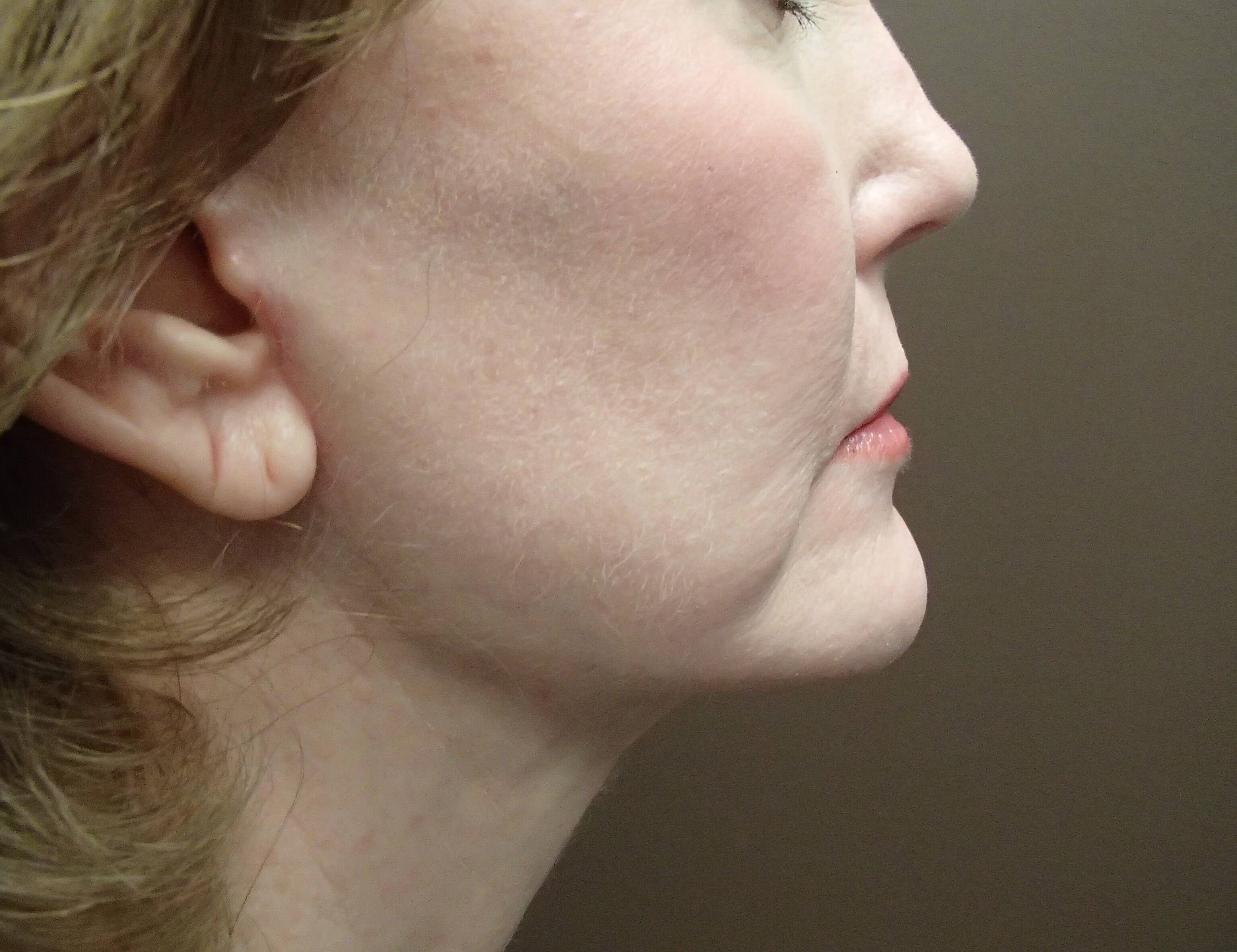 Facelift After