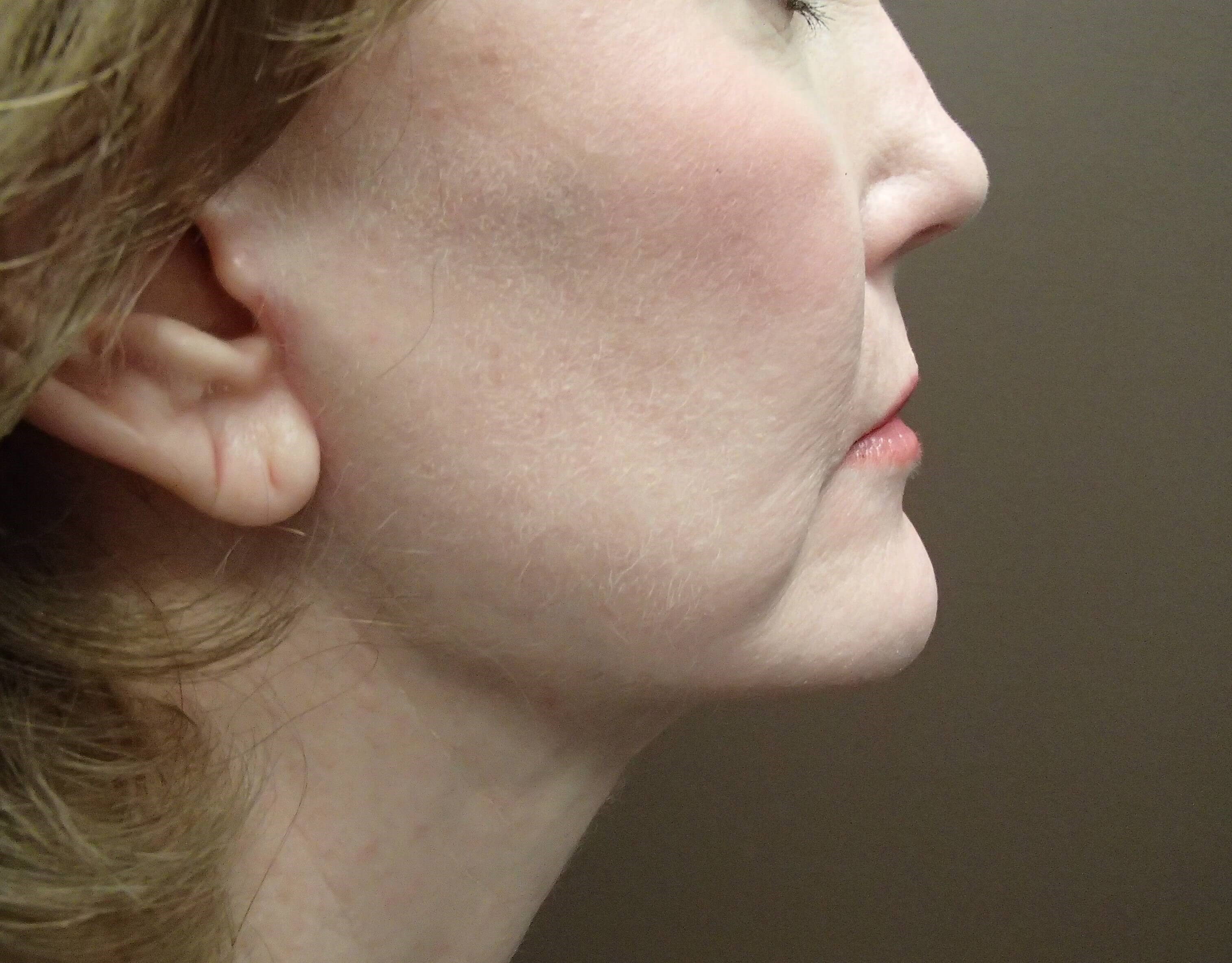 Facelift After