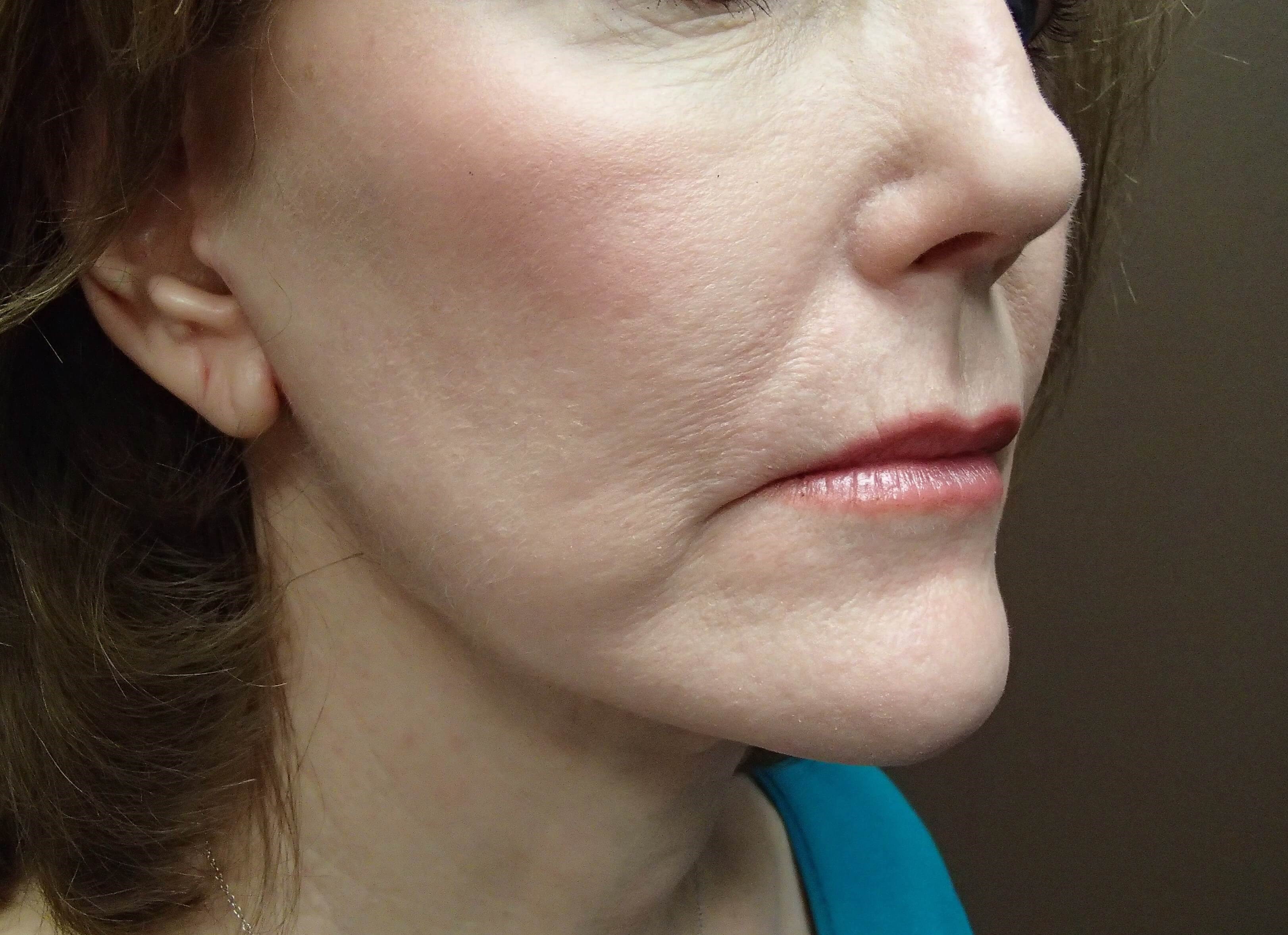 Facelift After