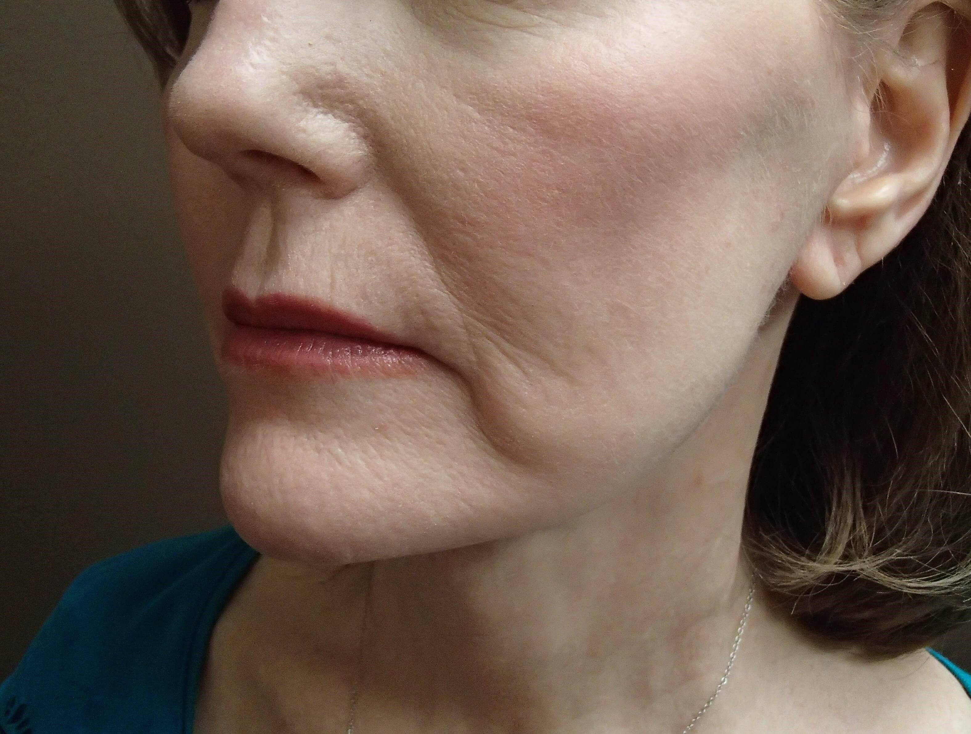 Facelift After