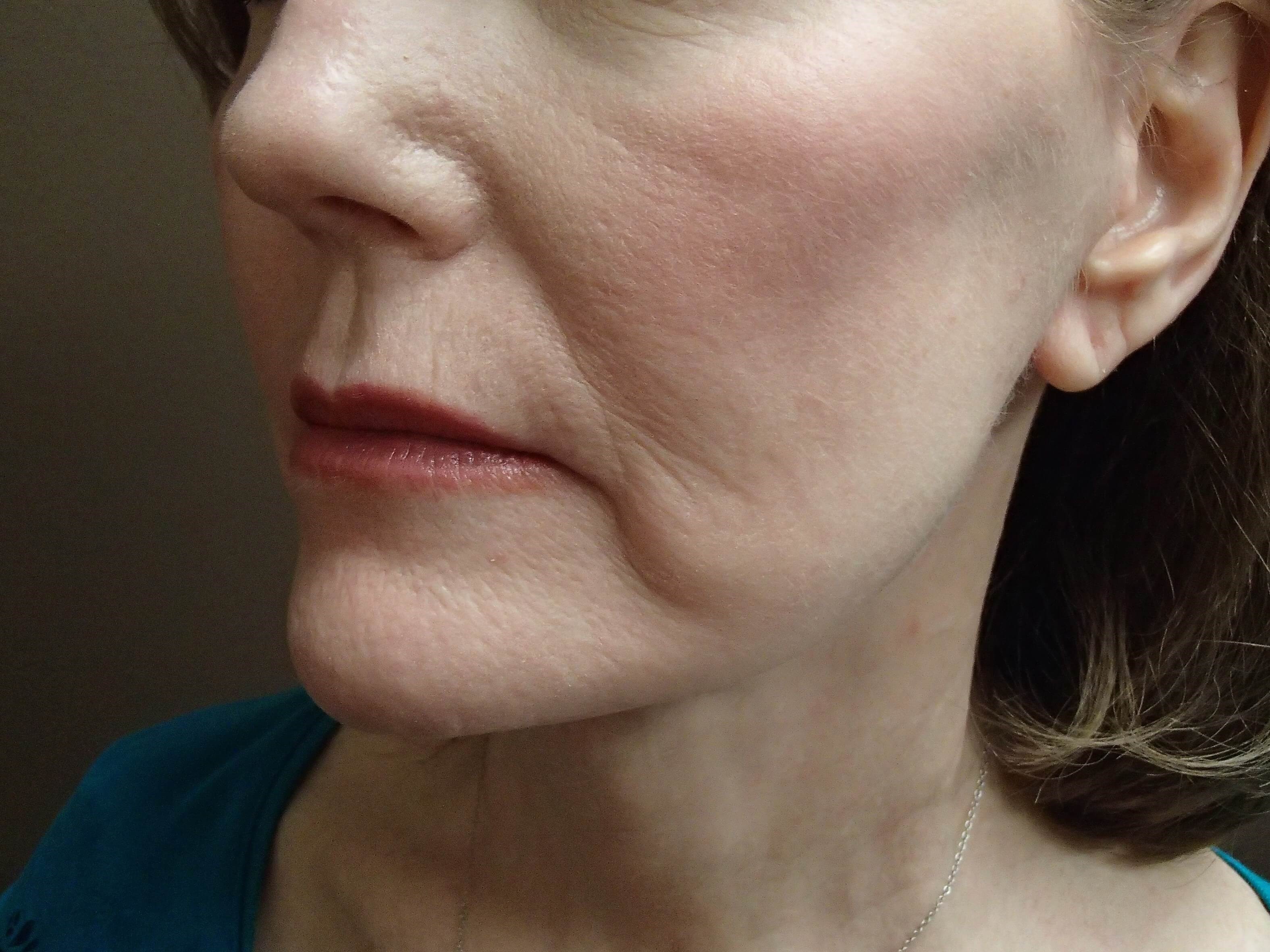 Facelift After