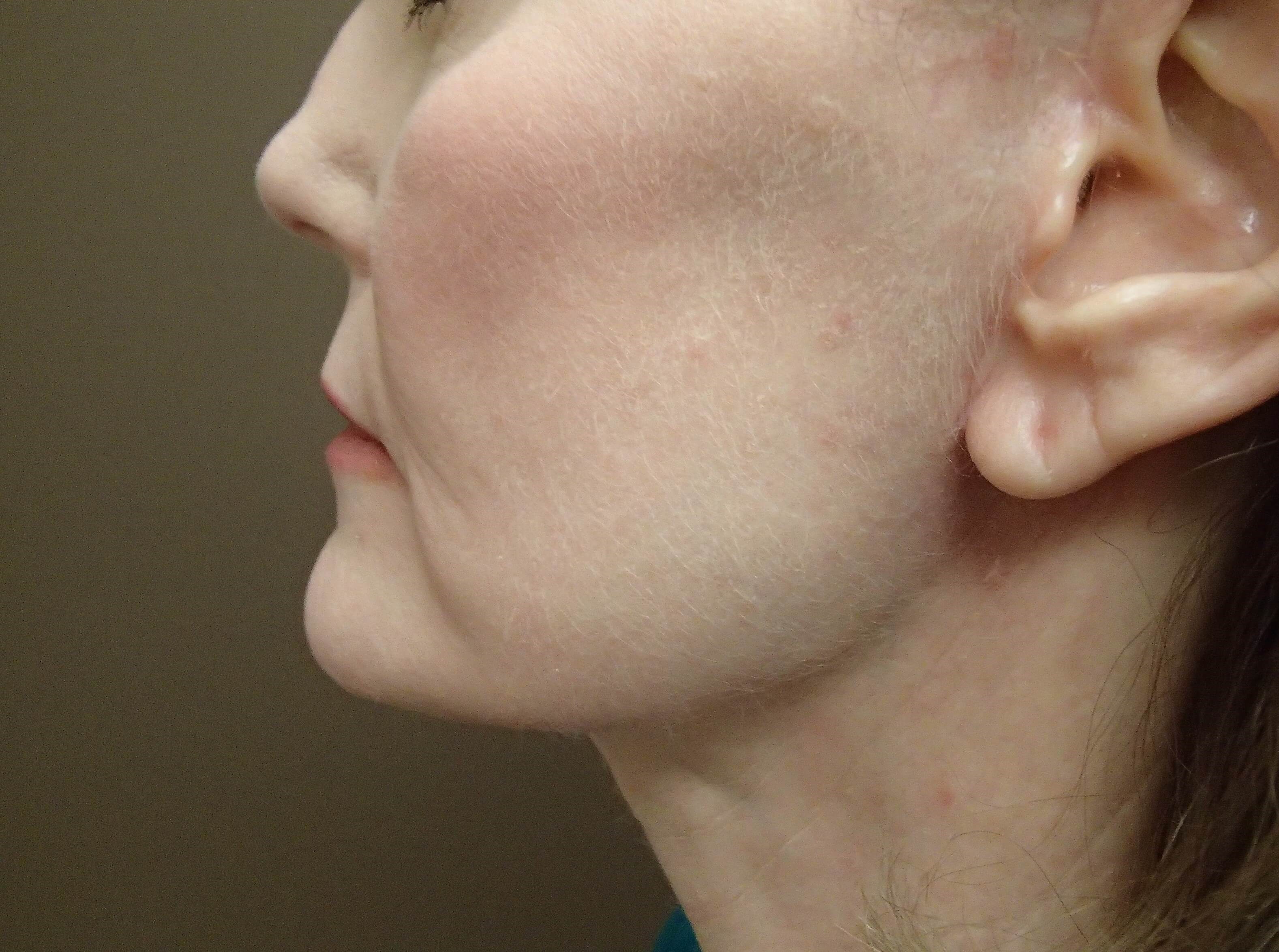 Facelift After