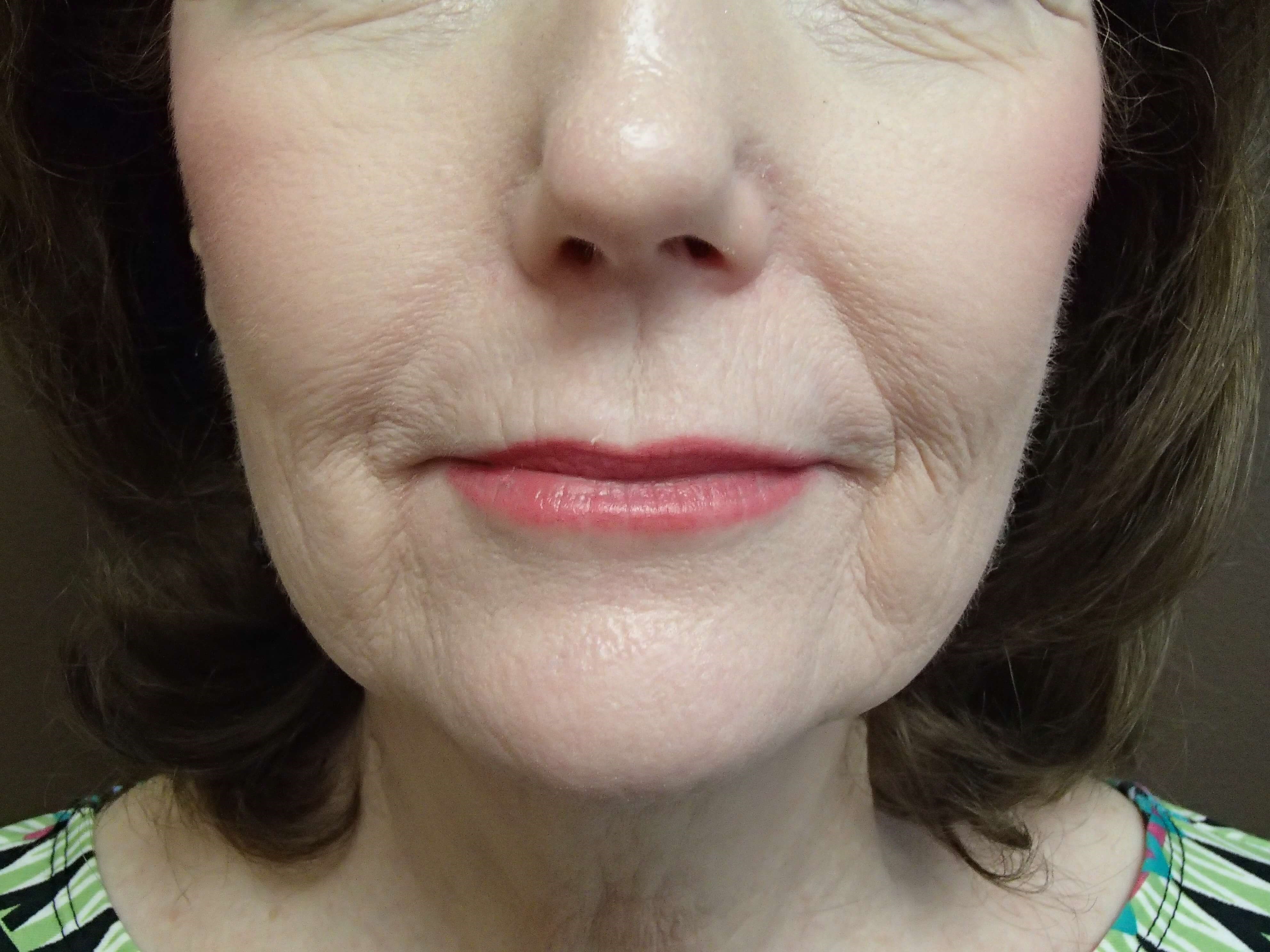 Facelift Before
