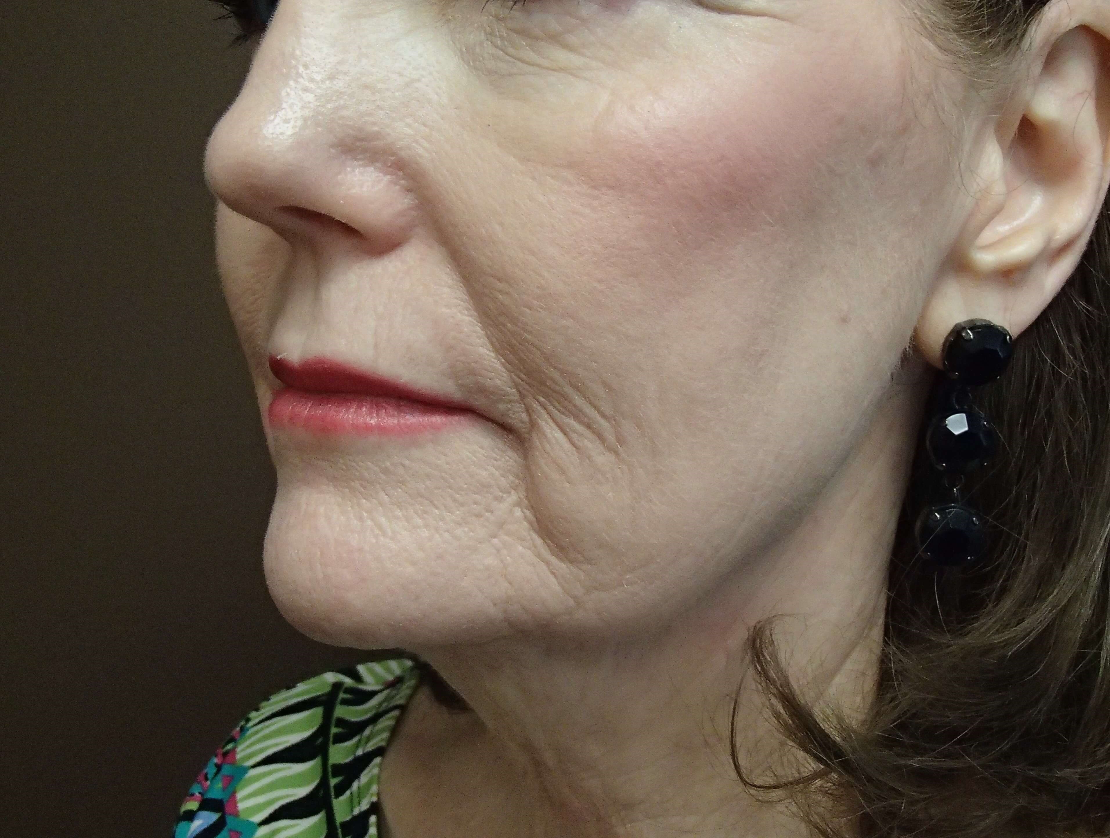 Facelift Before