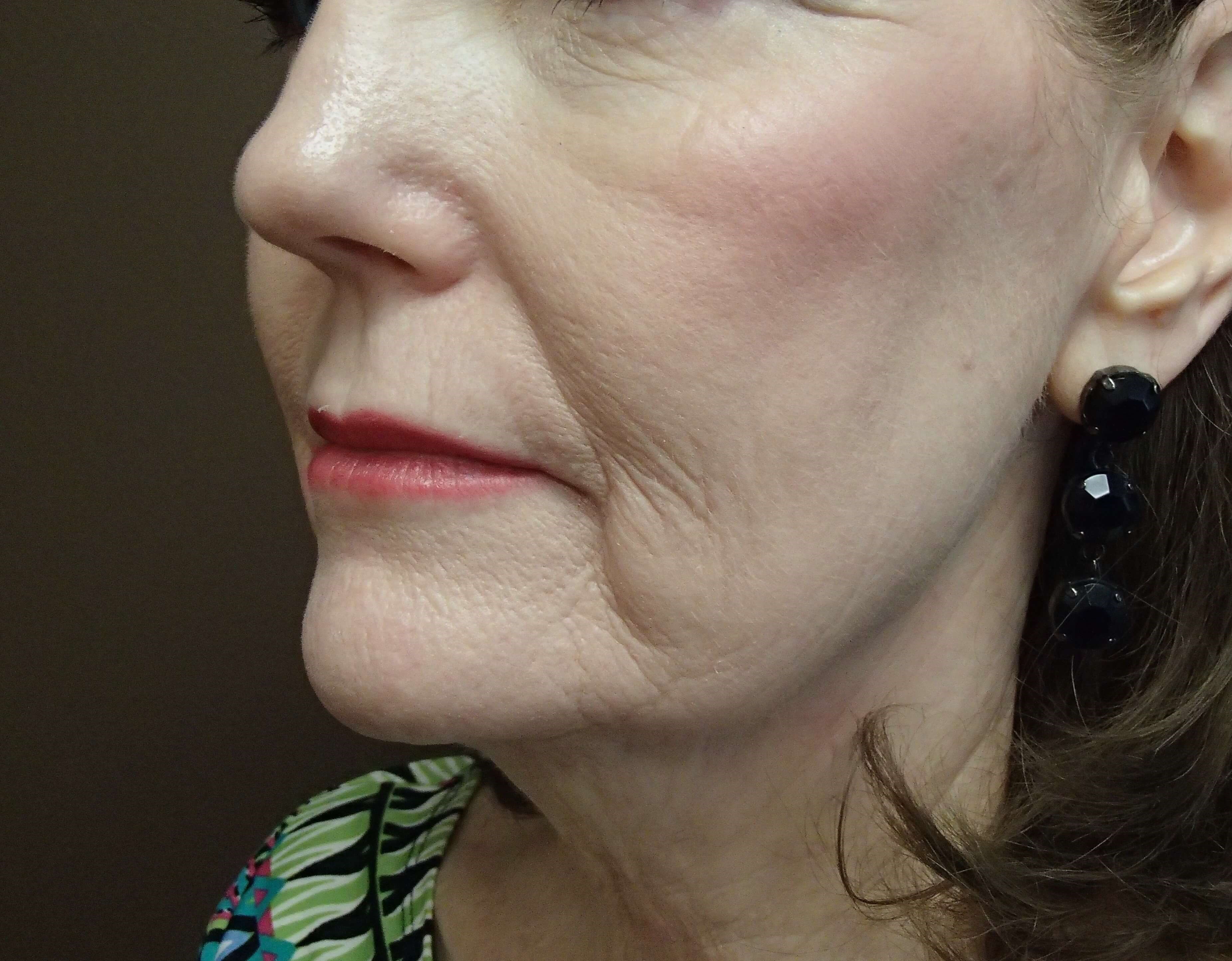 Facelift Before
