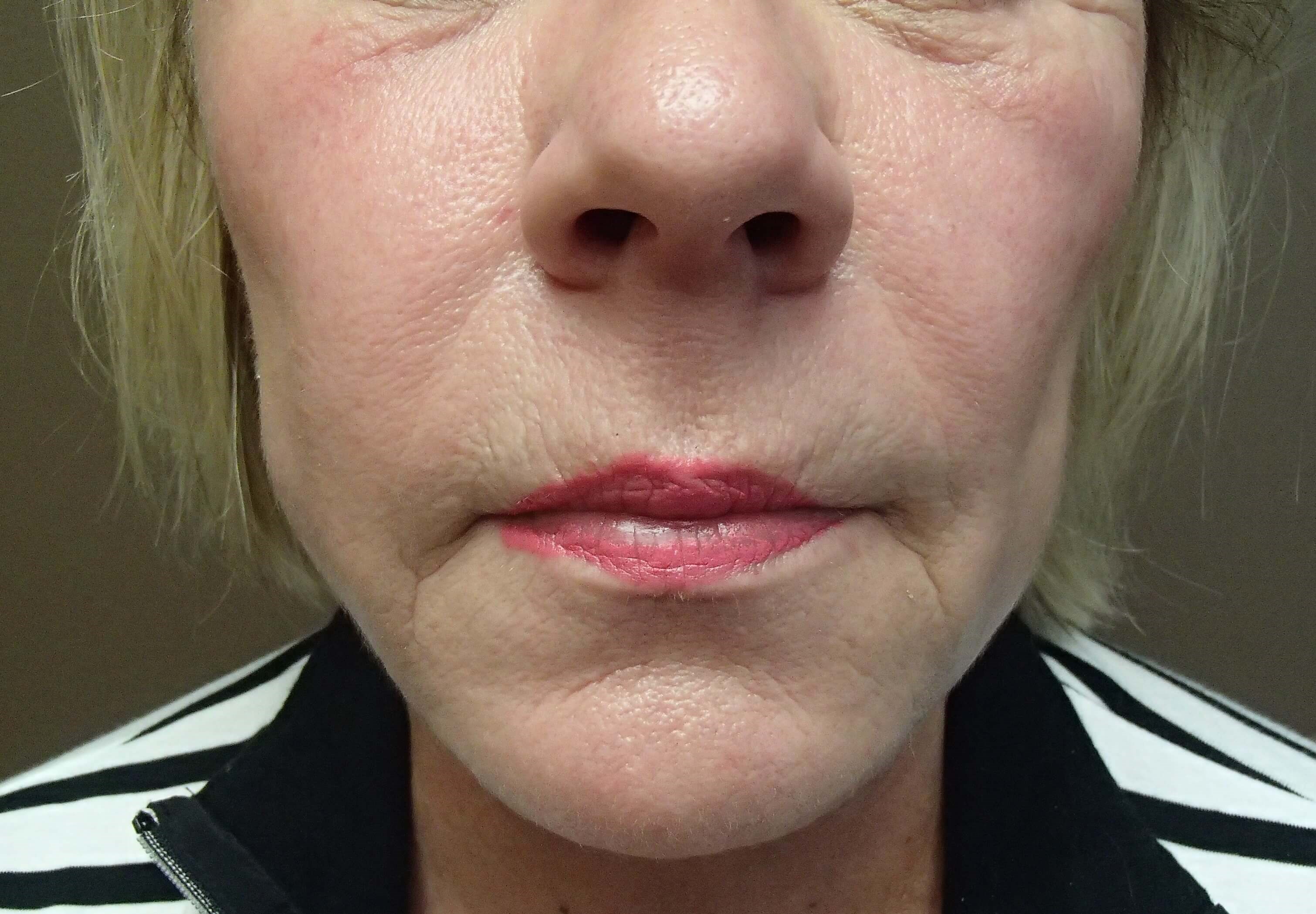 Facelift After