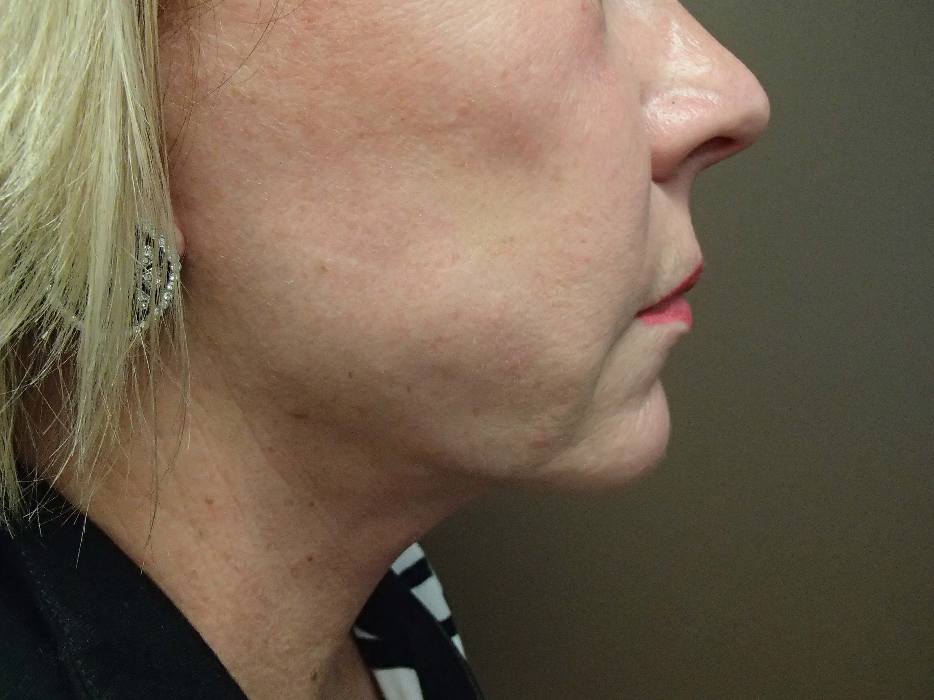 Facelift After