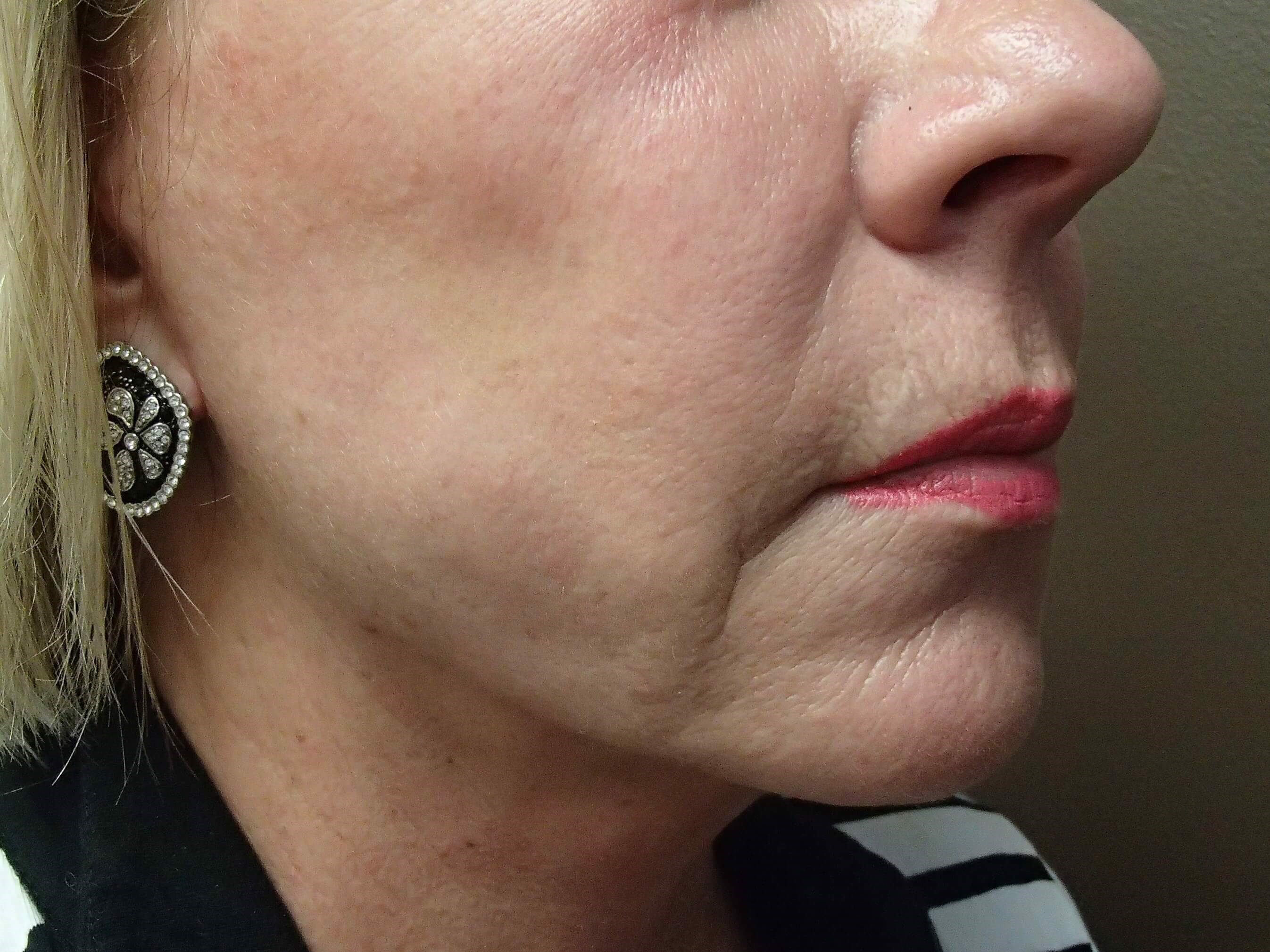 Facelift After