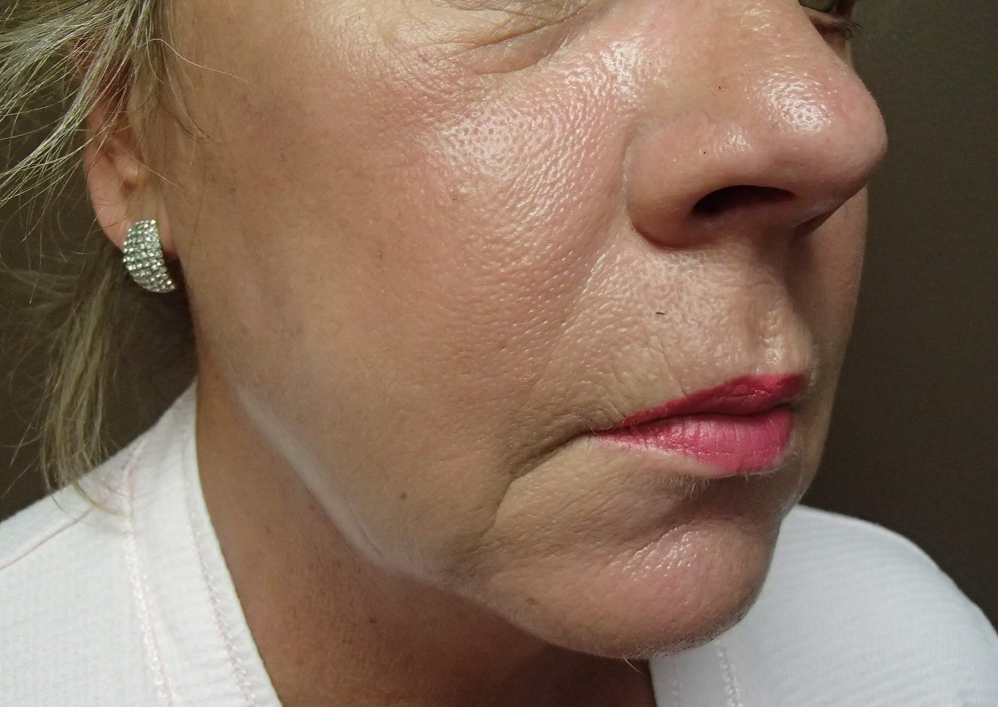 Facelift Before