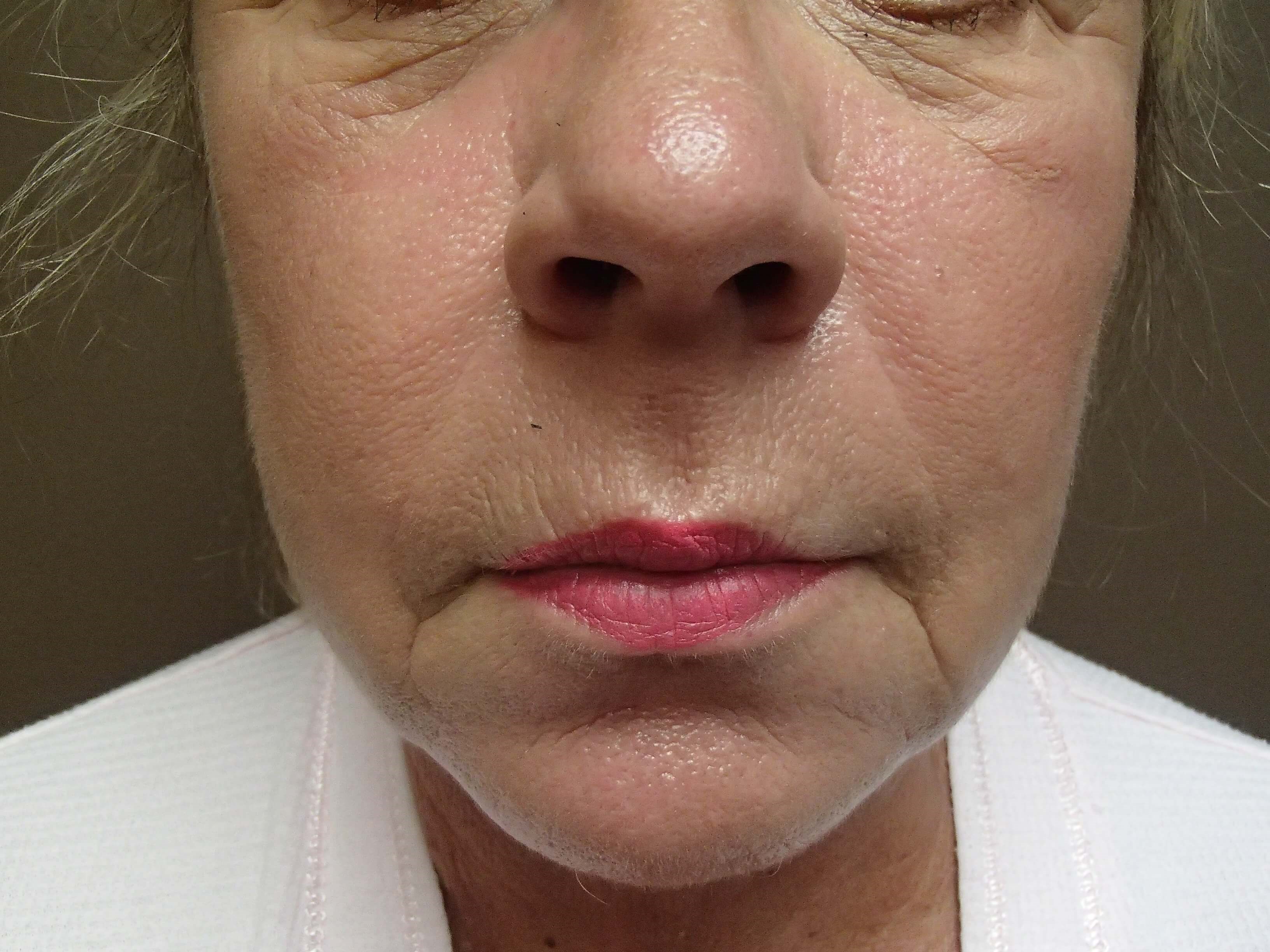 Facelift Before