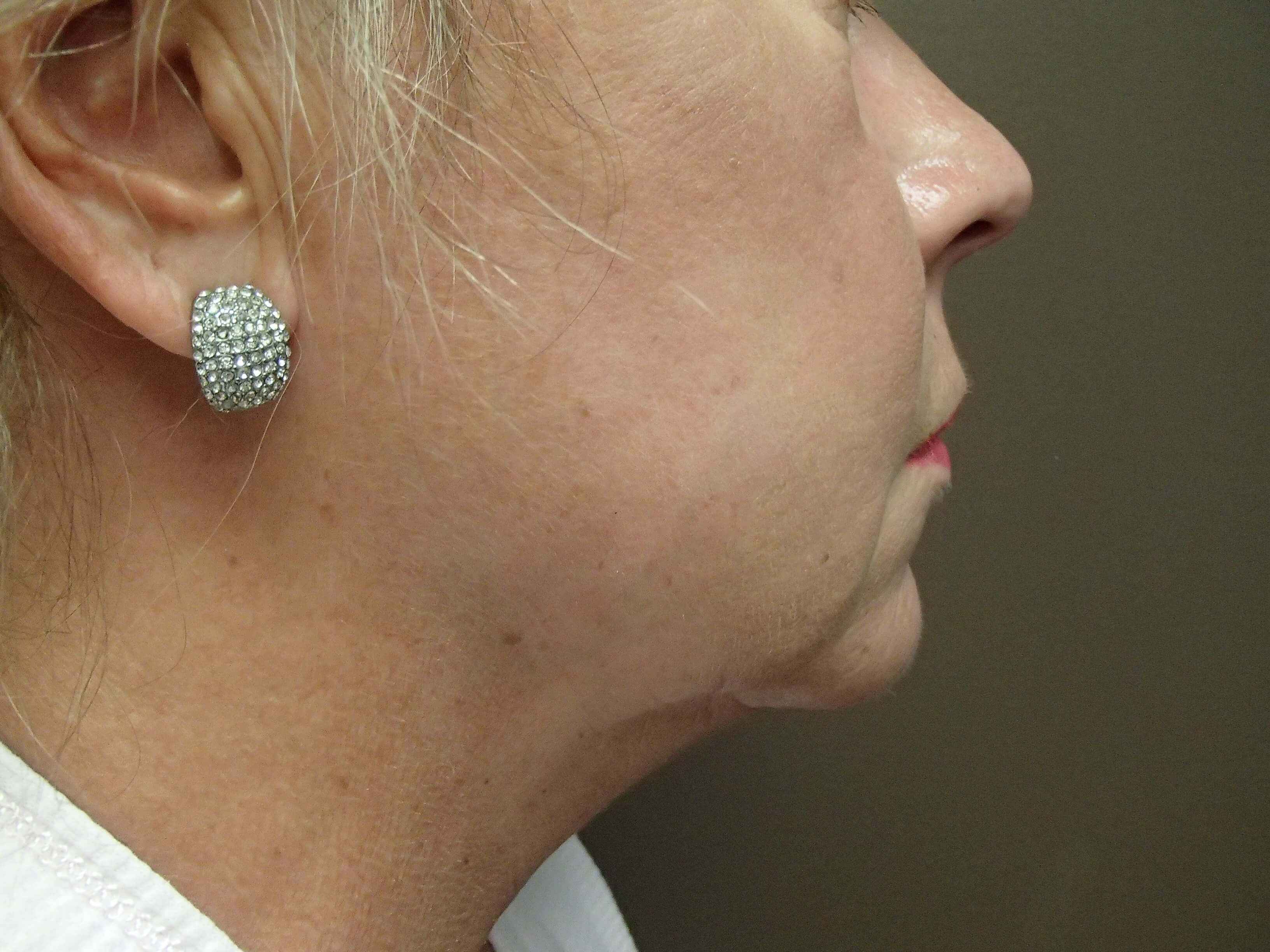 Facelift Before