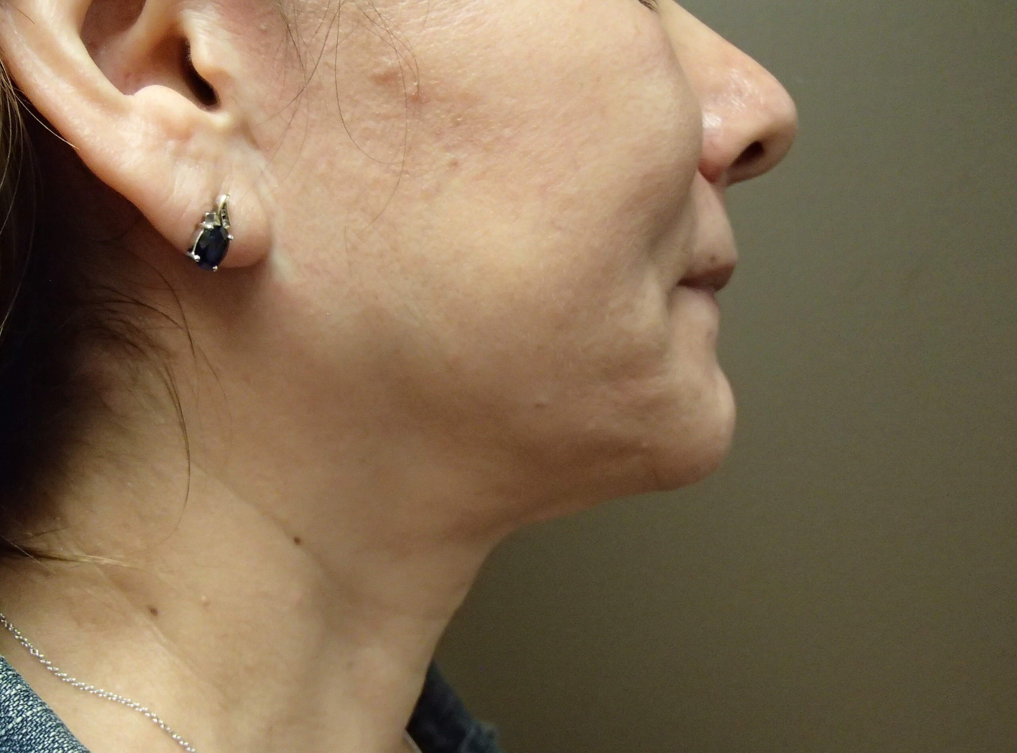 Facelift After