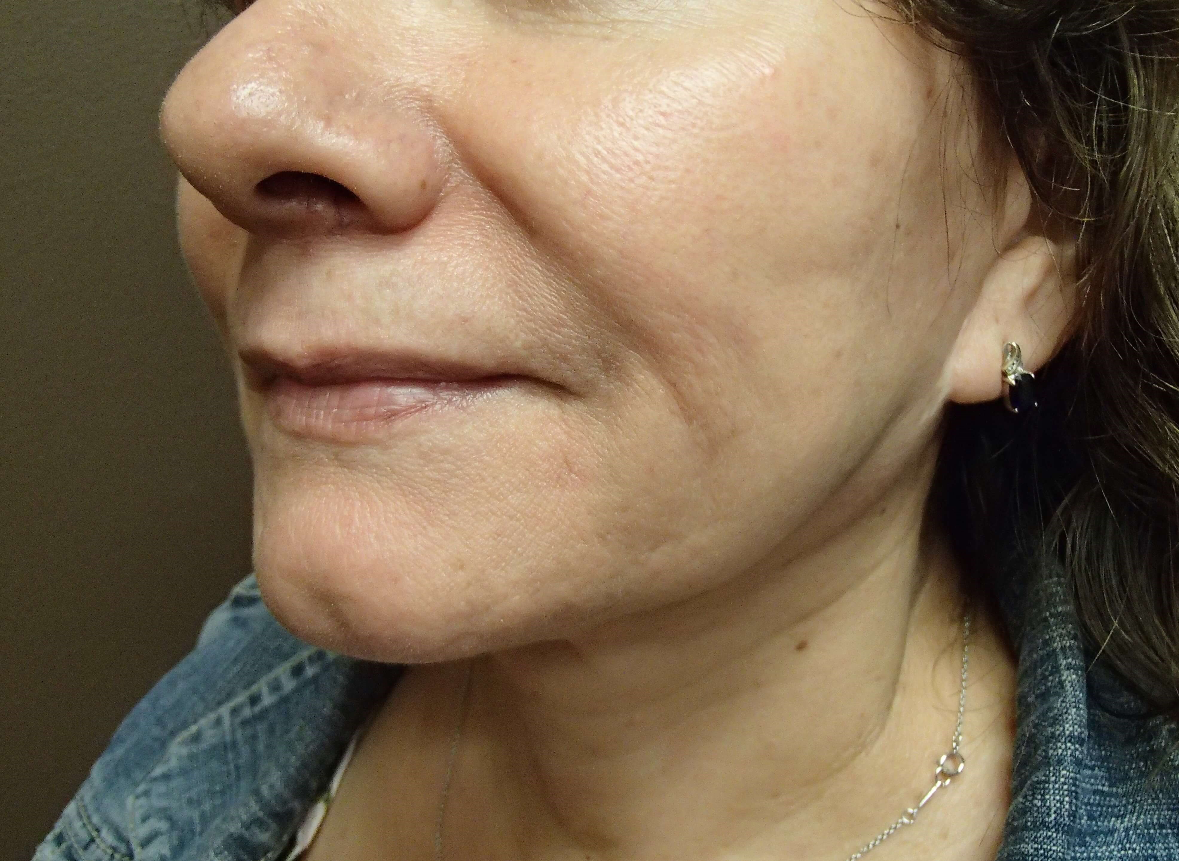 Facelift After