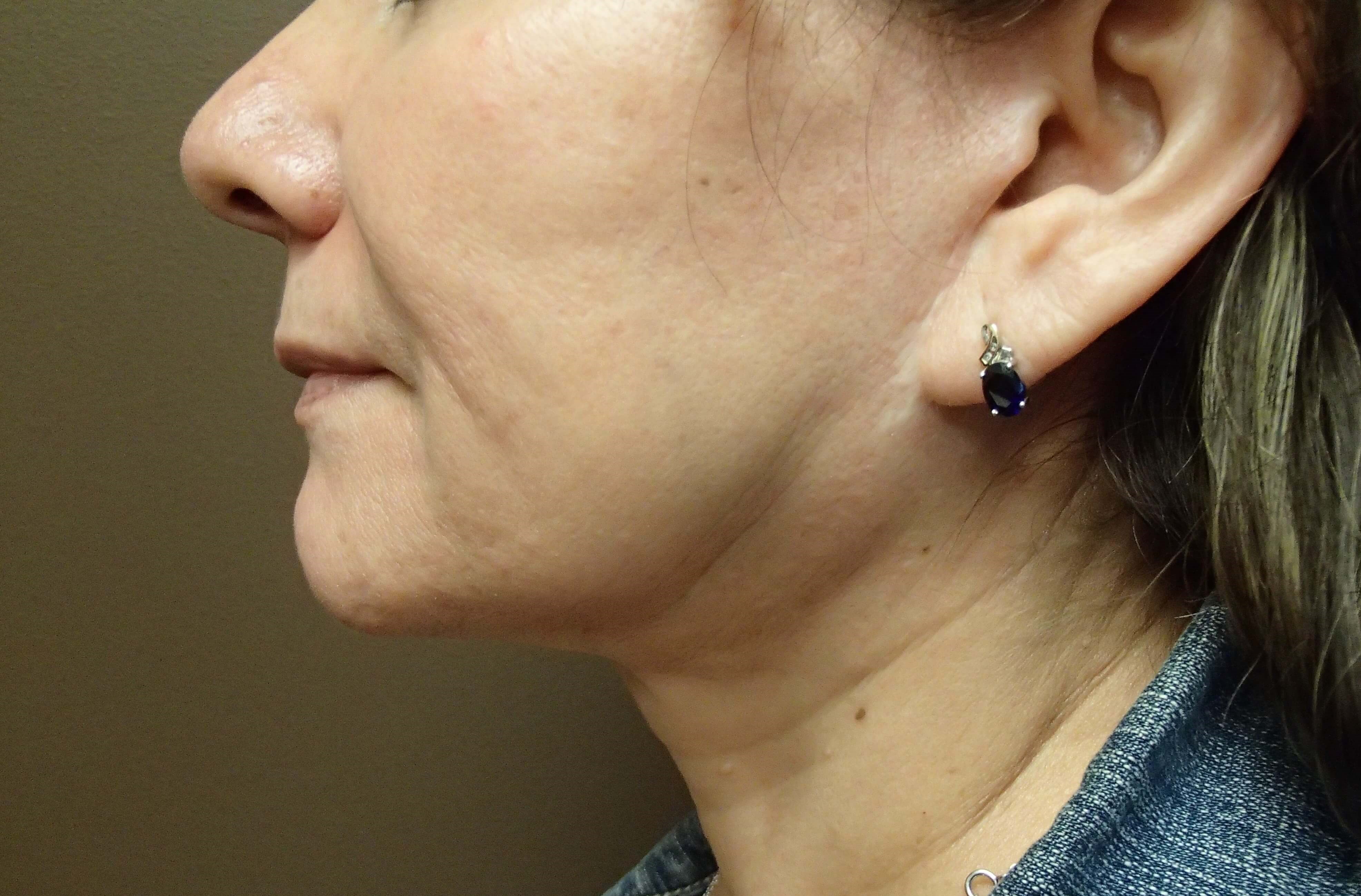Facelift After