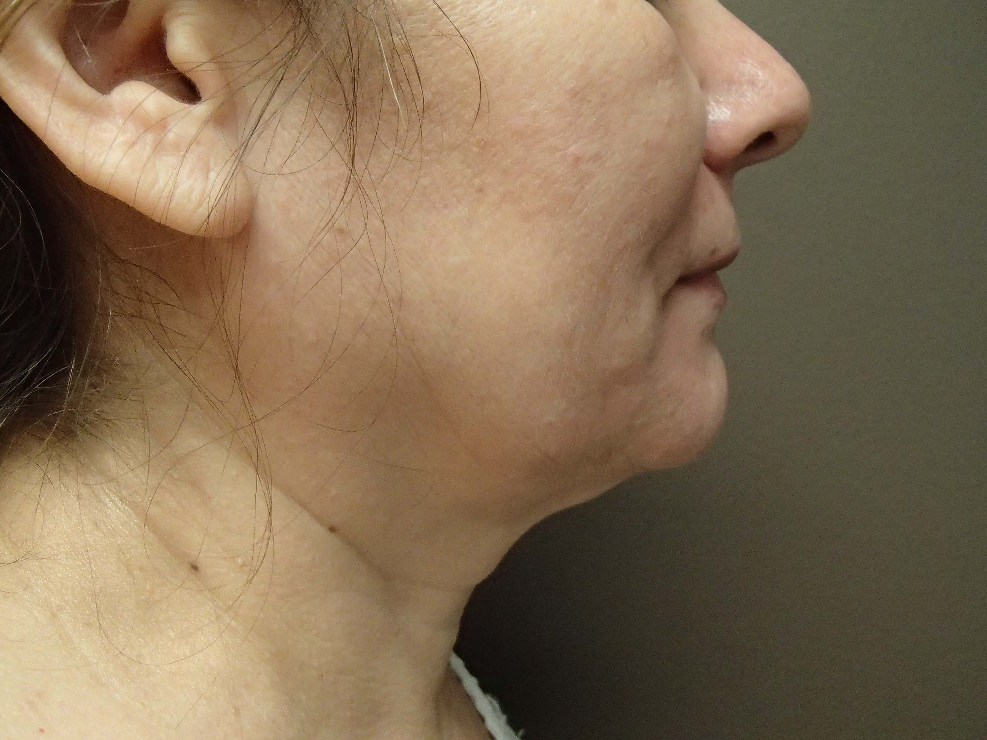 Facelift Before