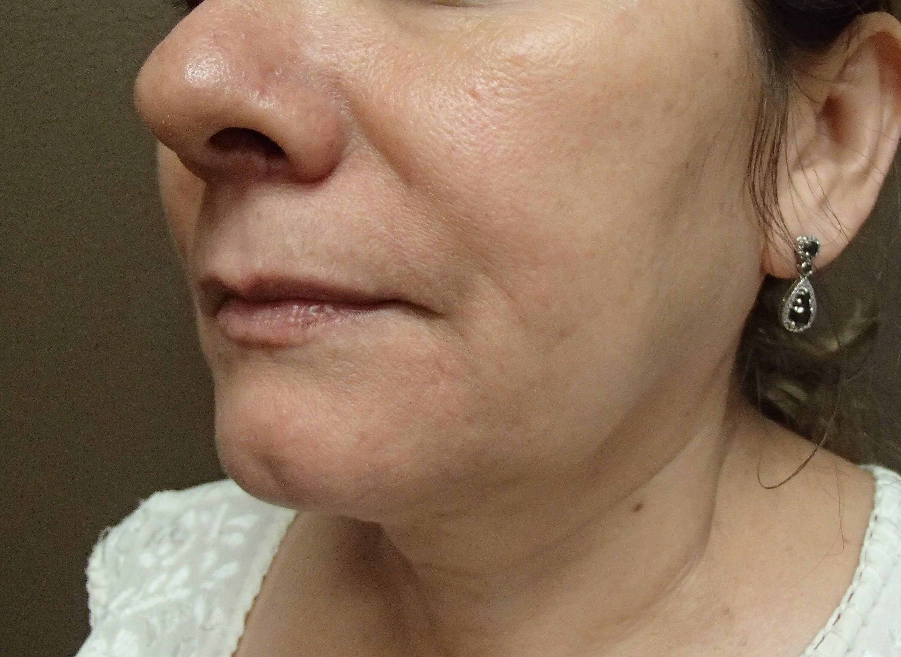 Facelift Before