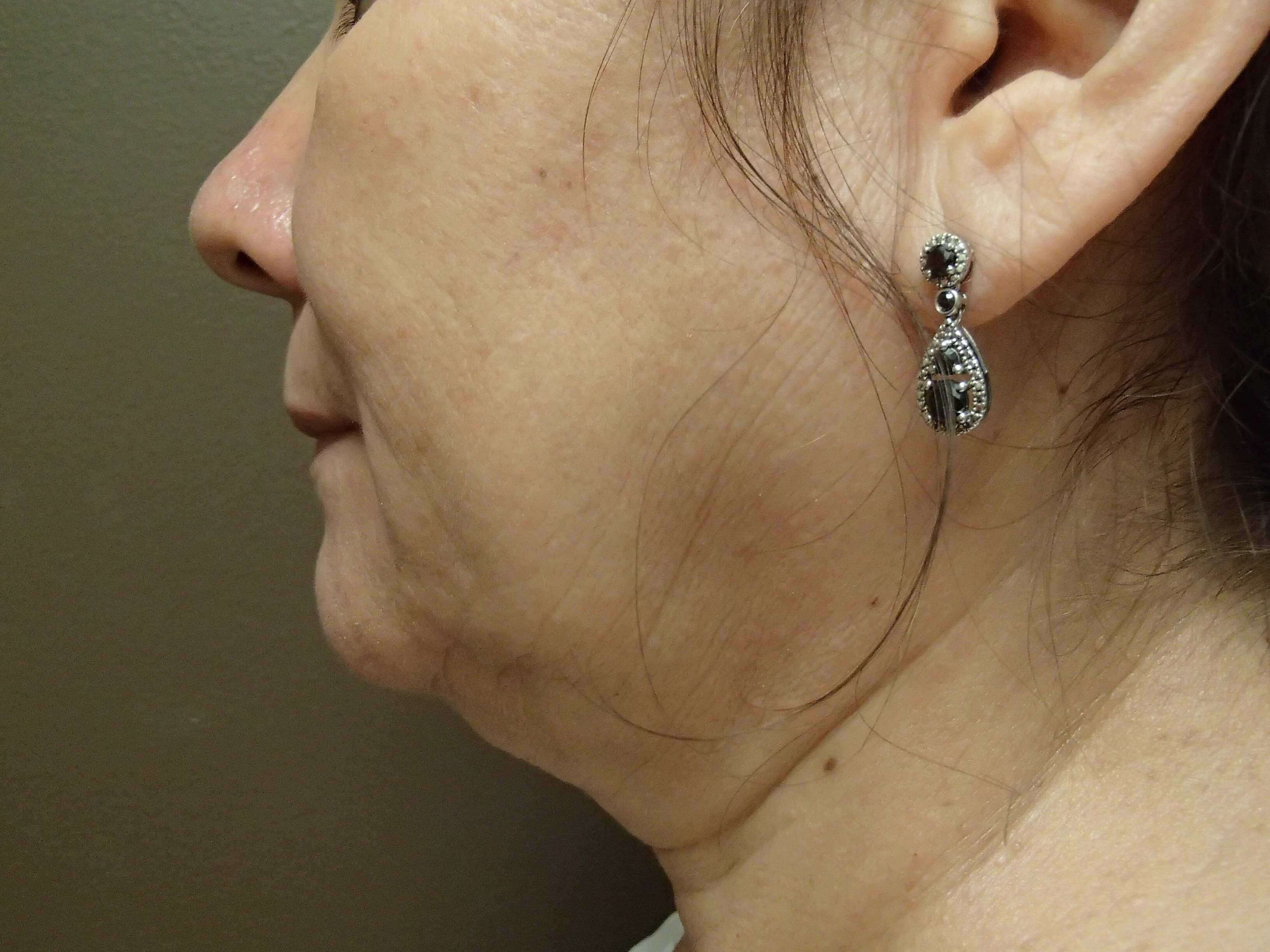 Facelift Before