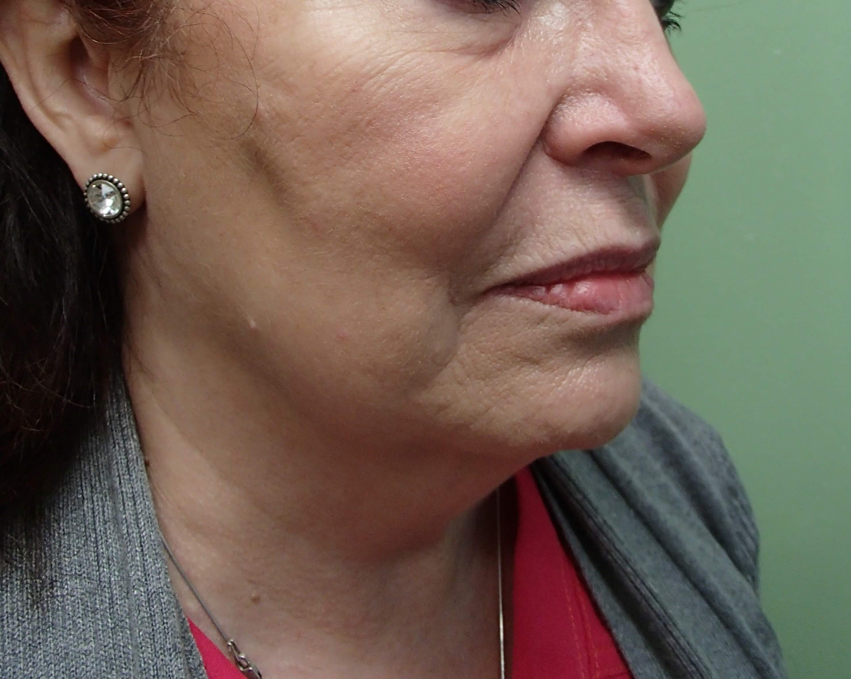 Facelift and Necklift Before