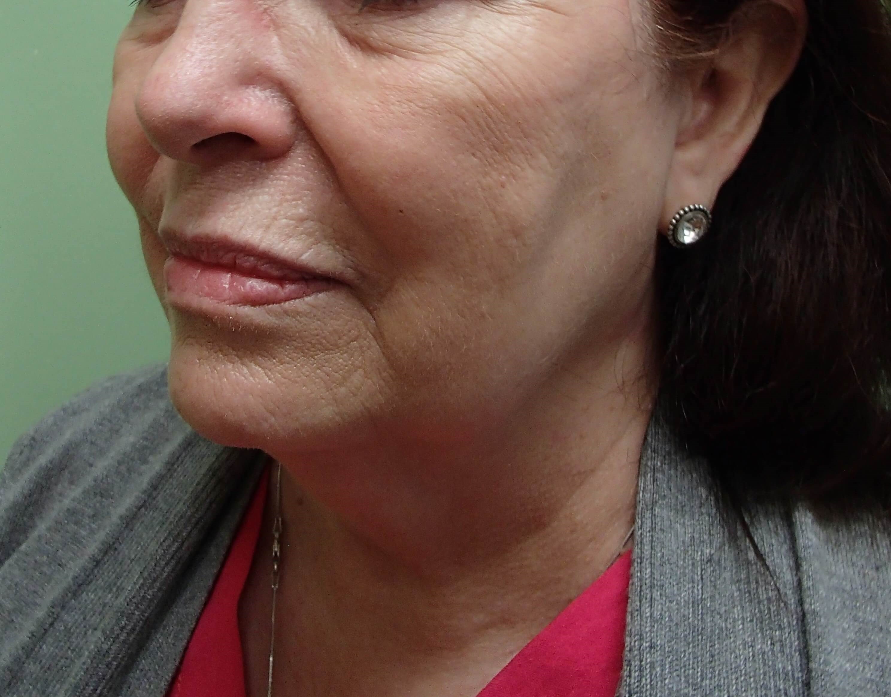 Facelift and Necklift Before