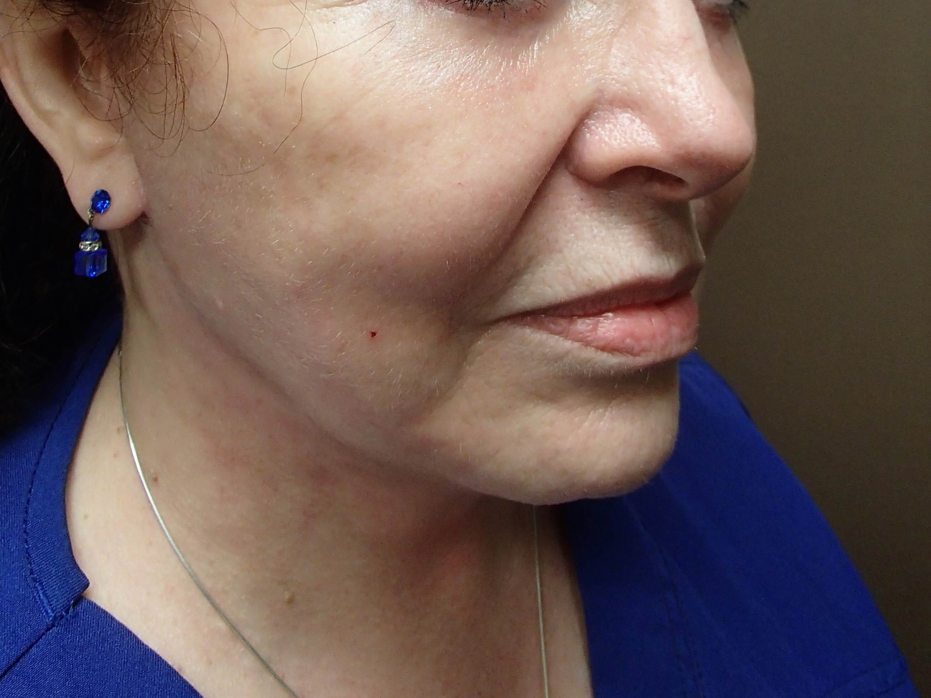 Facelift and Necklift After