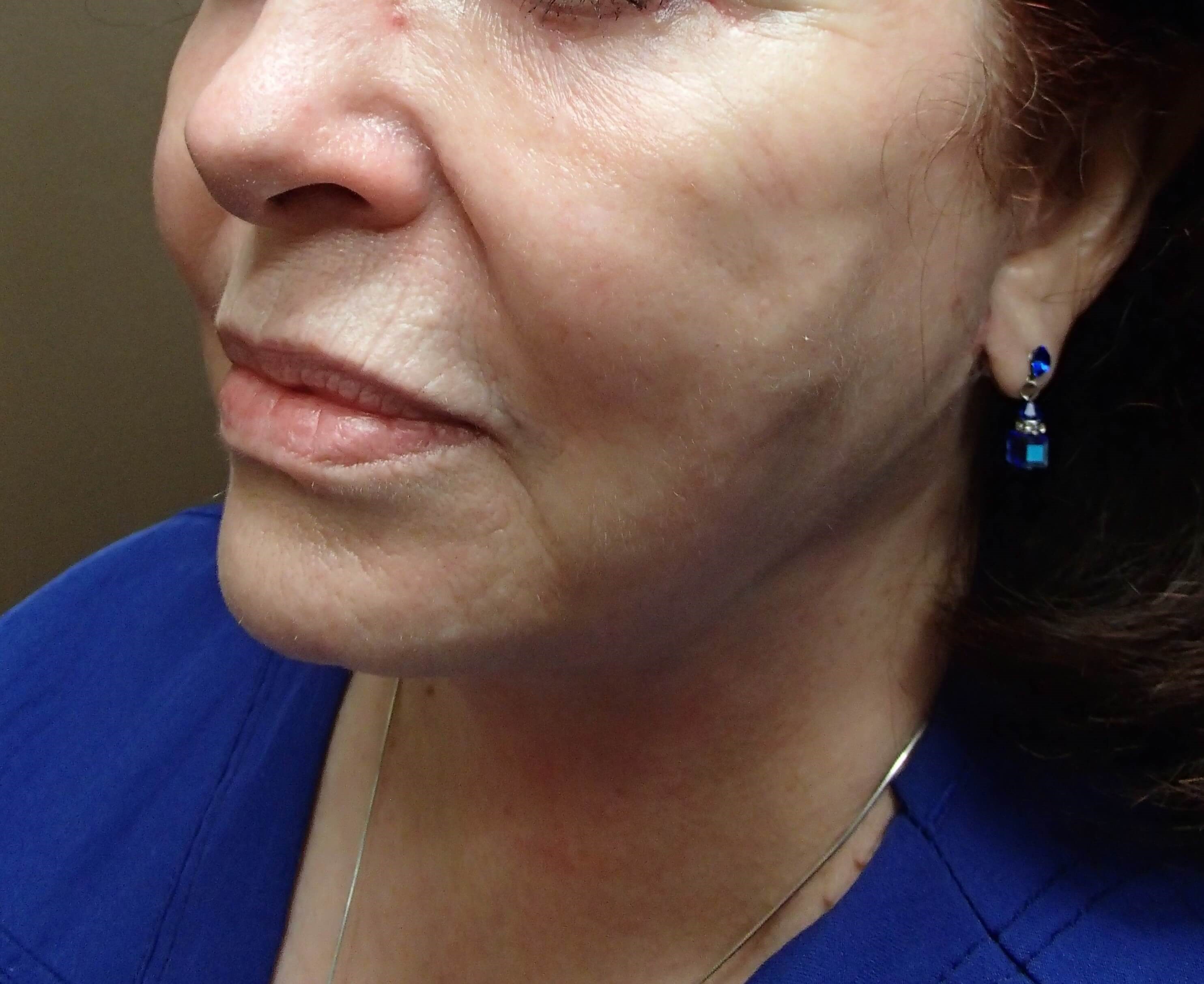 Facelift and Necklift After