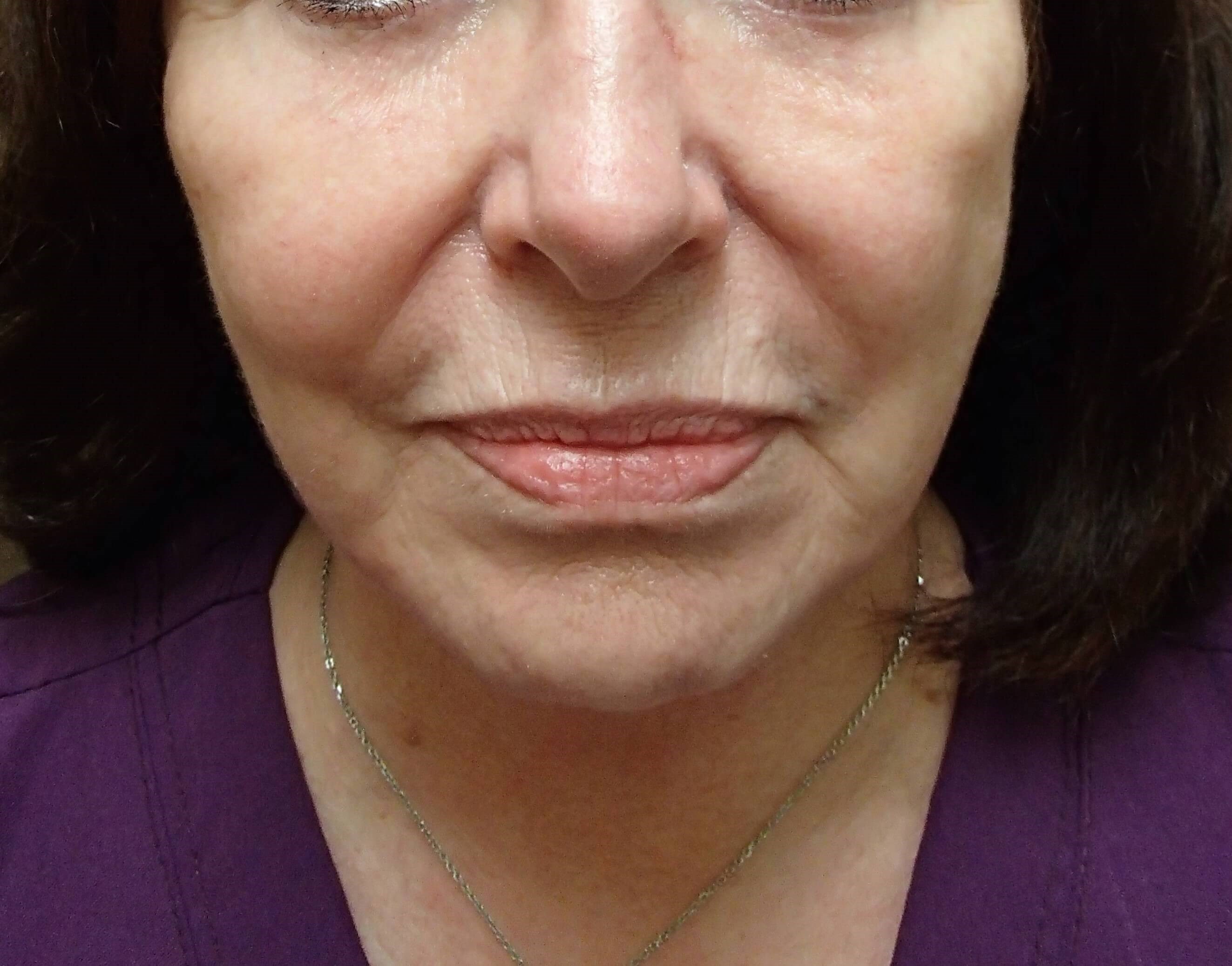 Facelift and Necklift After