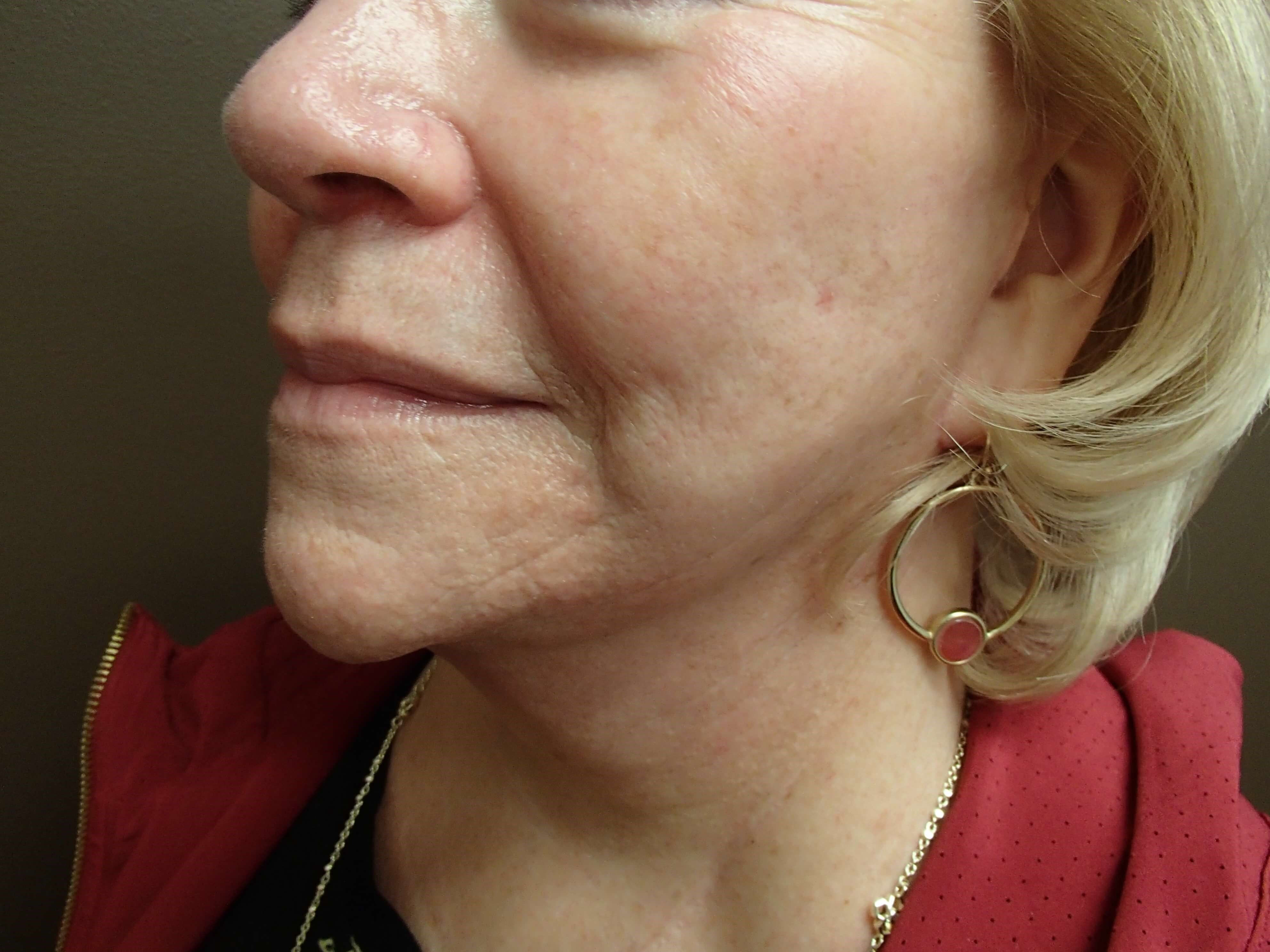 Facelift and Necklift After