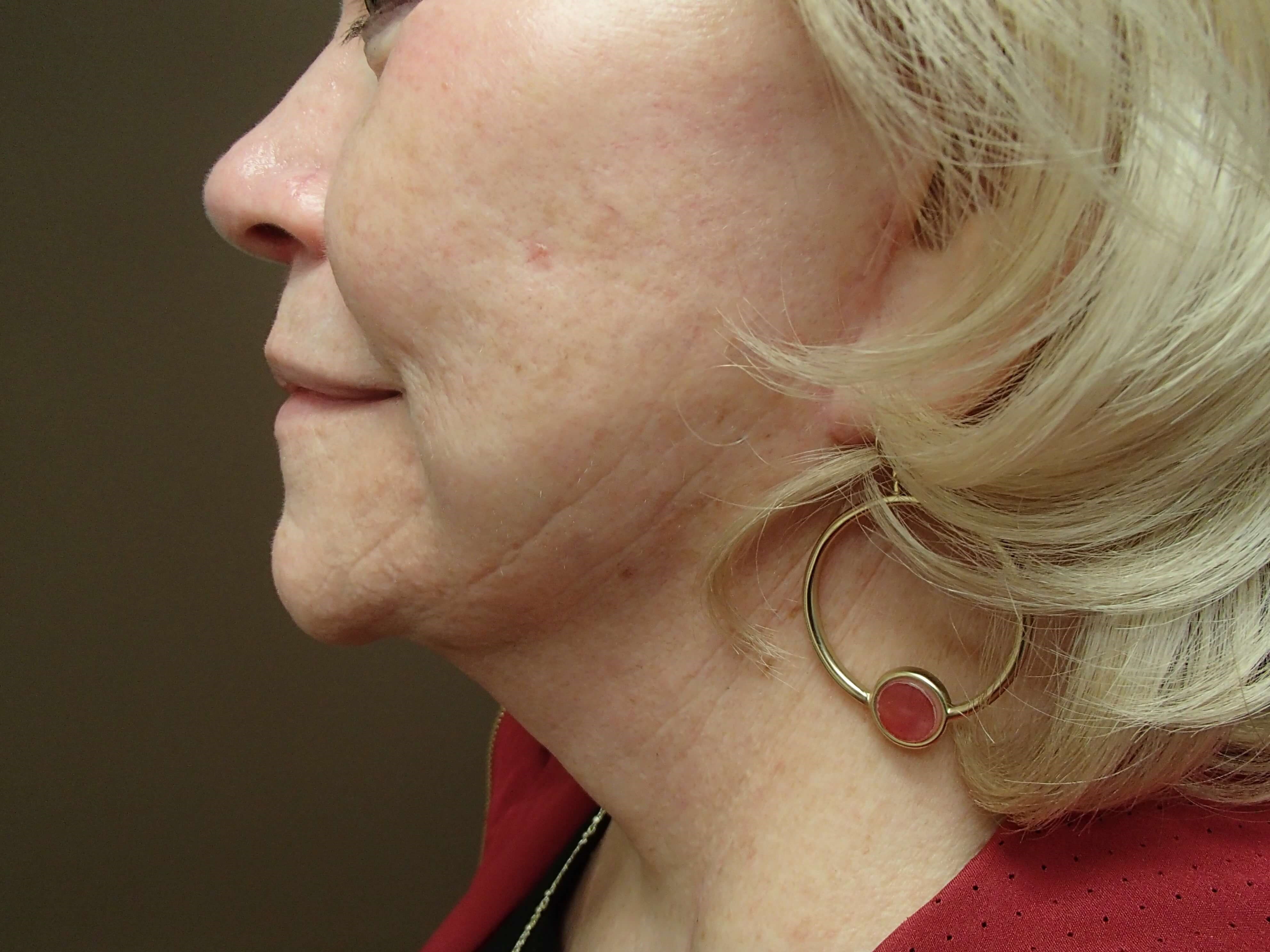 Facelift and Necklift After