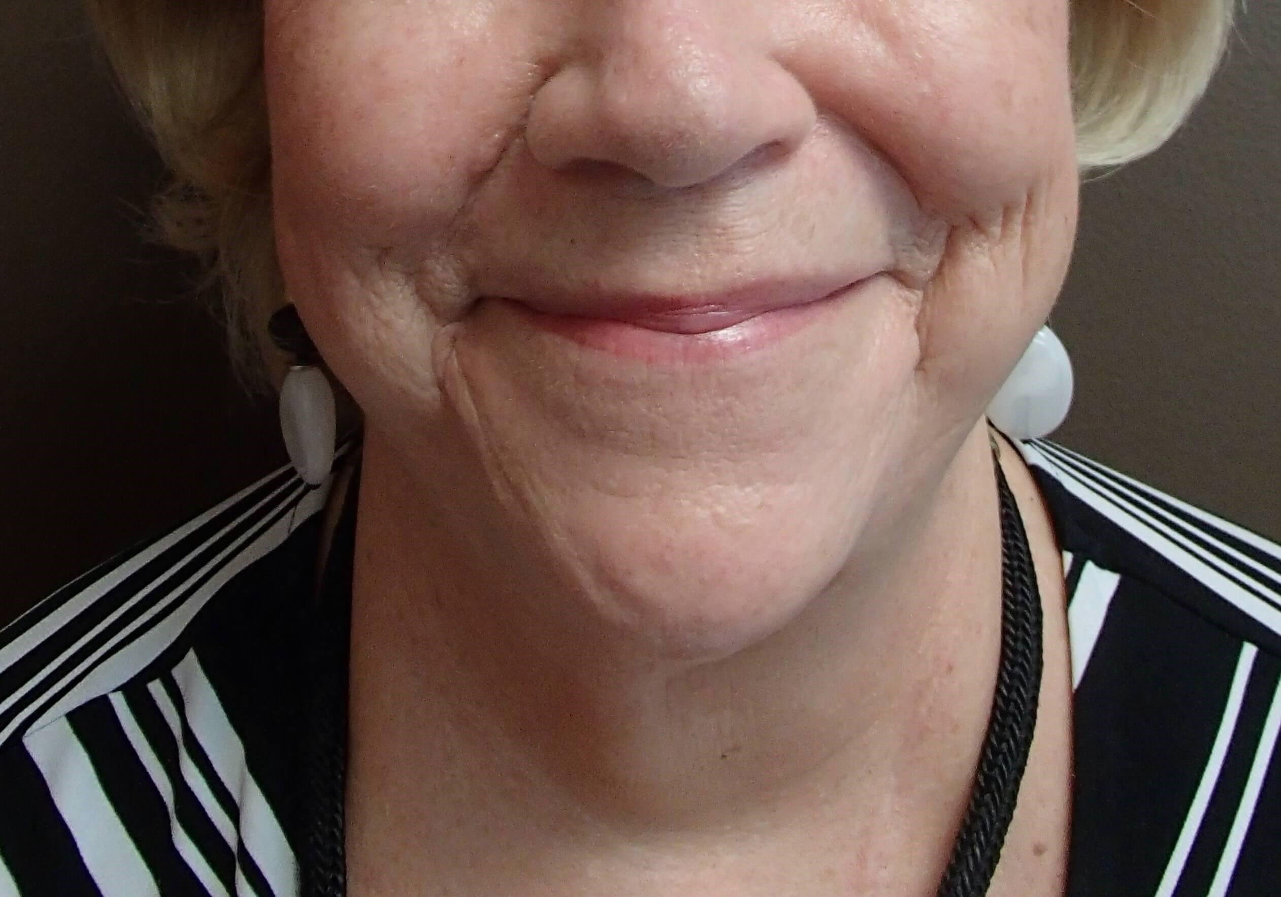 Facelift and Necklift Before
