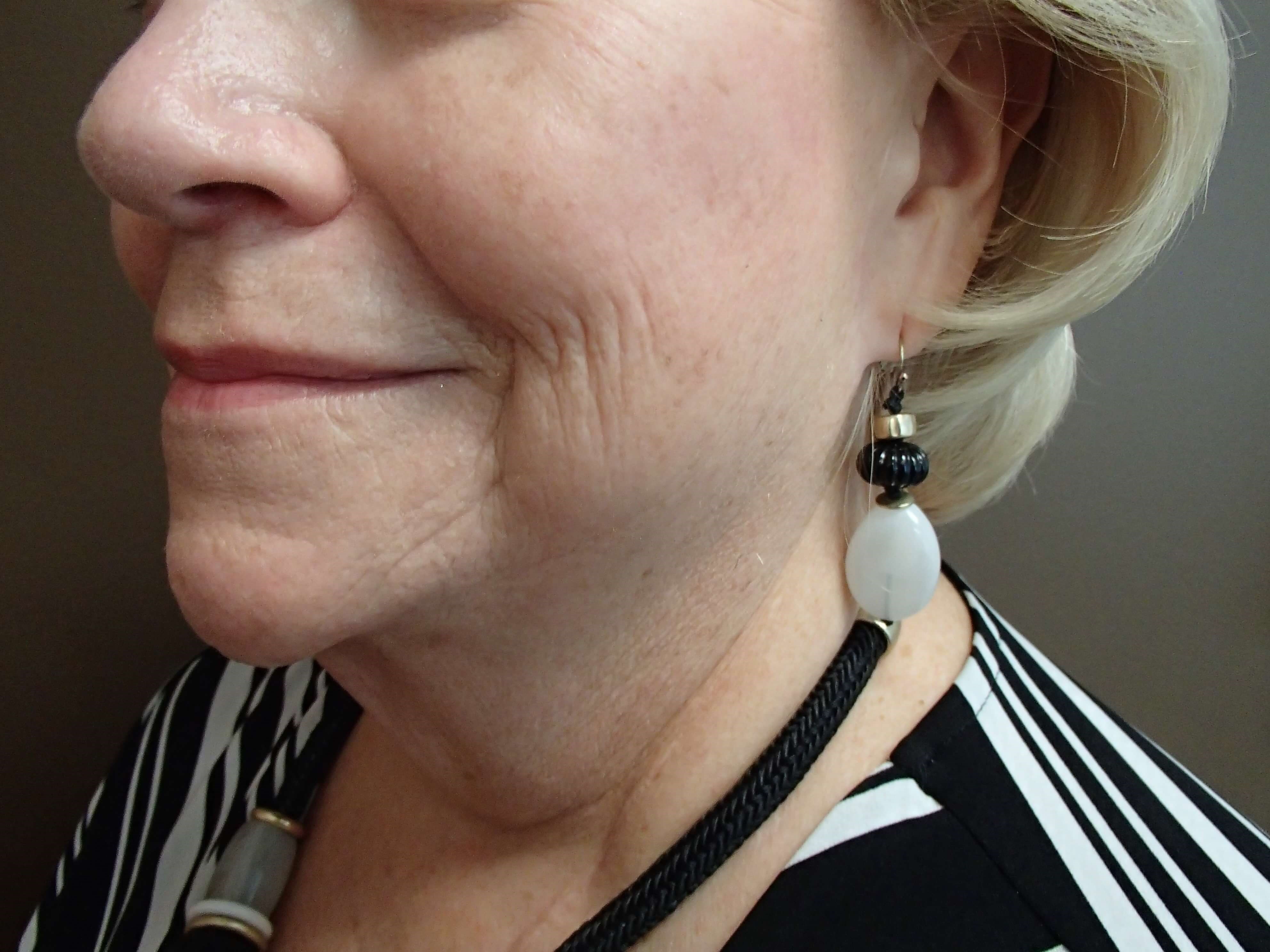 Facelift and Necklift Before