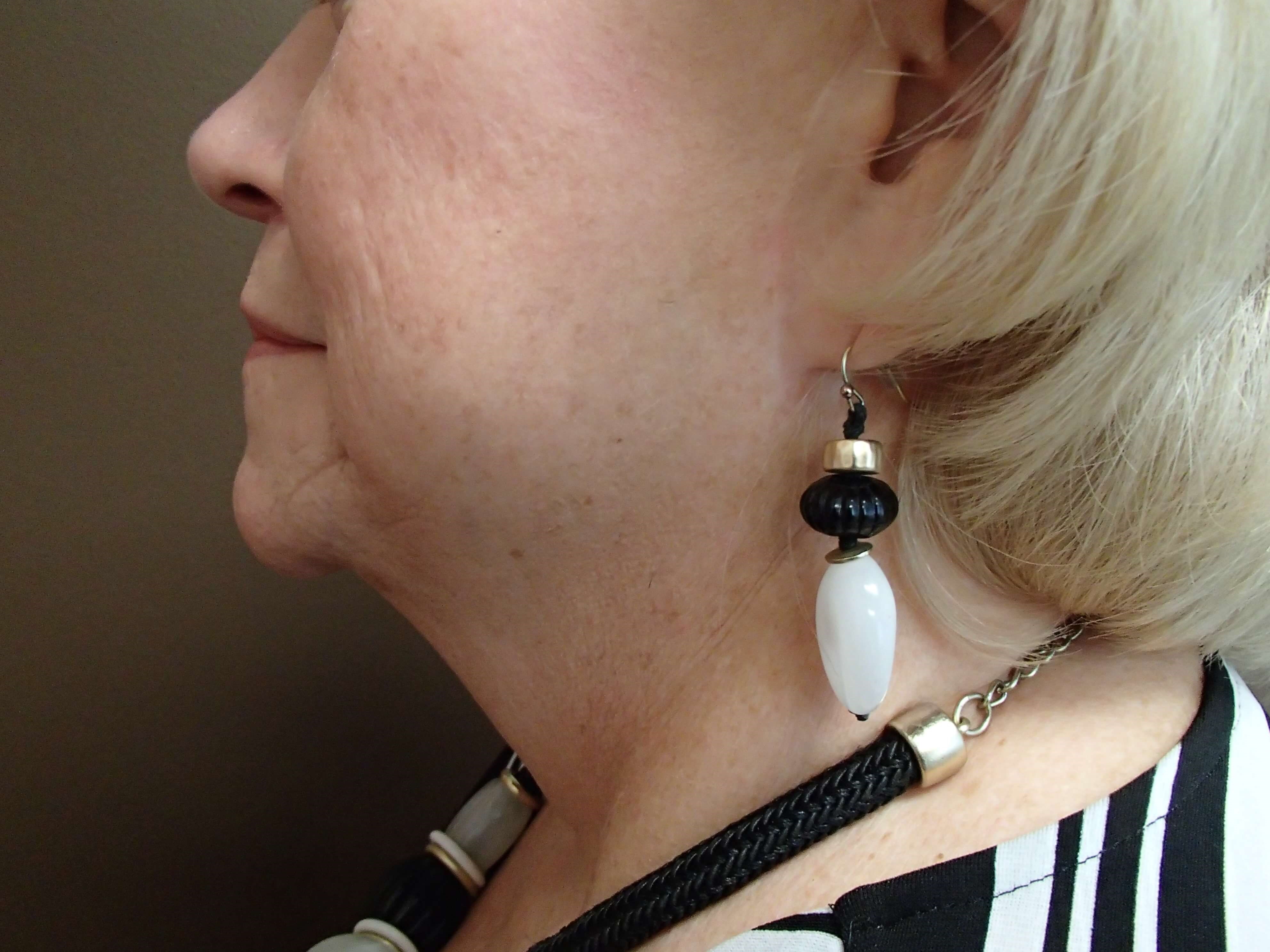 Facelift and Necklift Before
