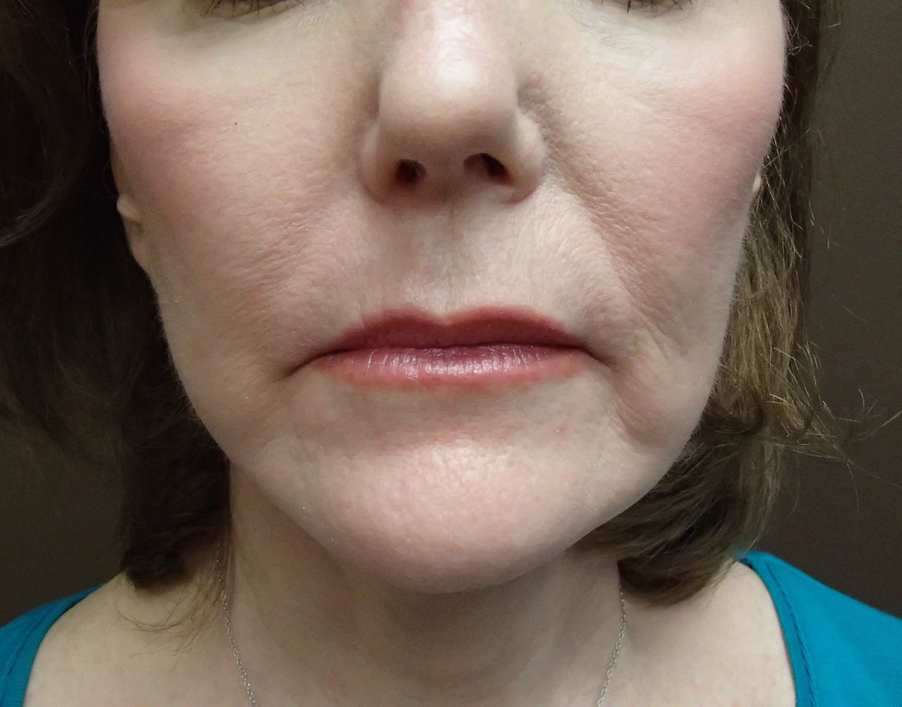 Facelift After