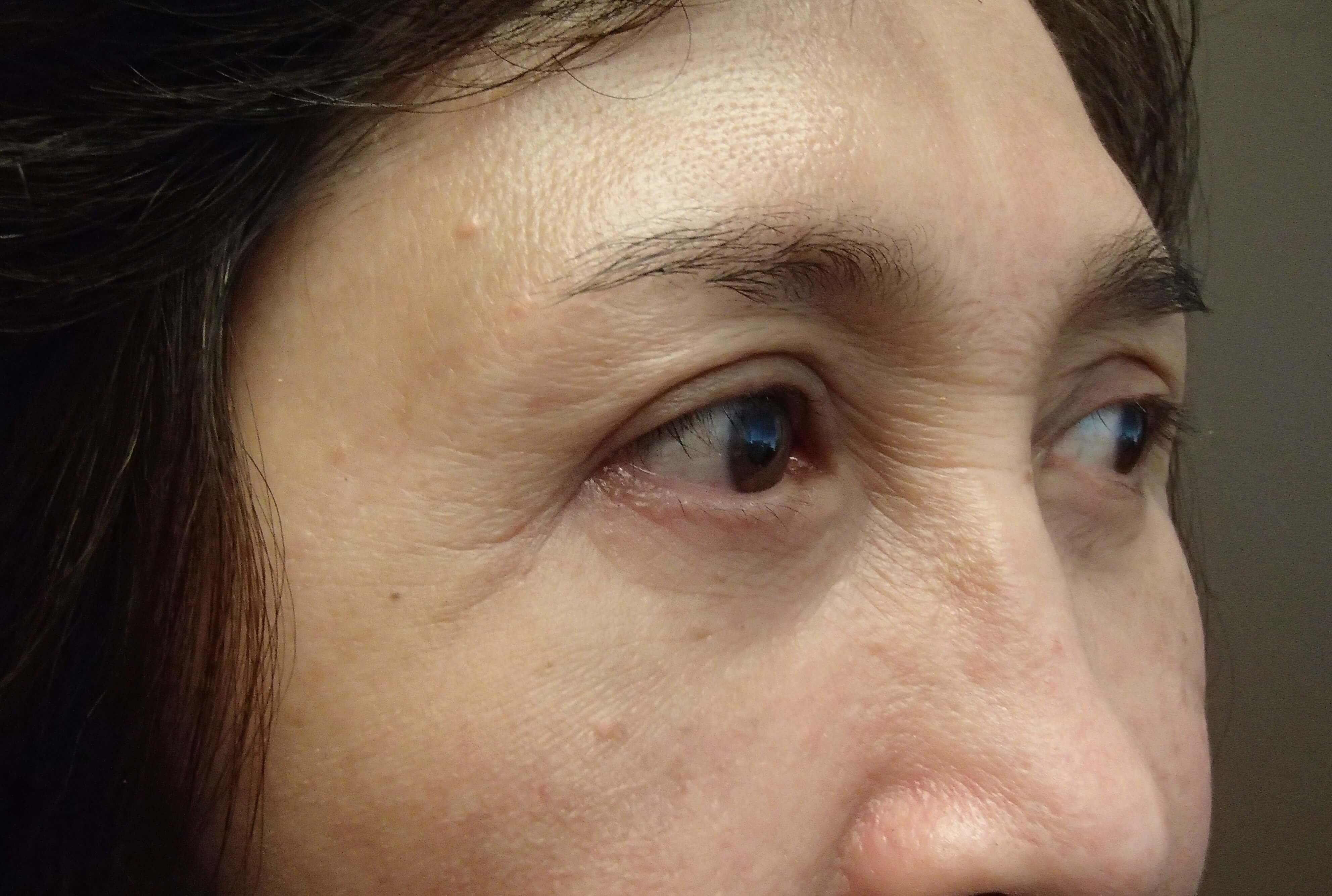 Asian Eyelid Lift After