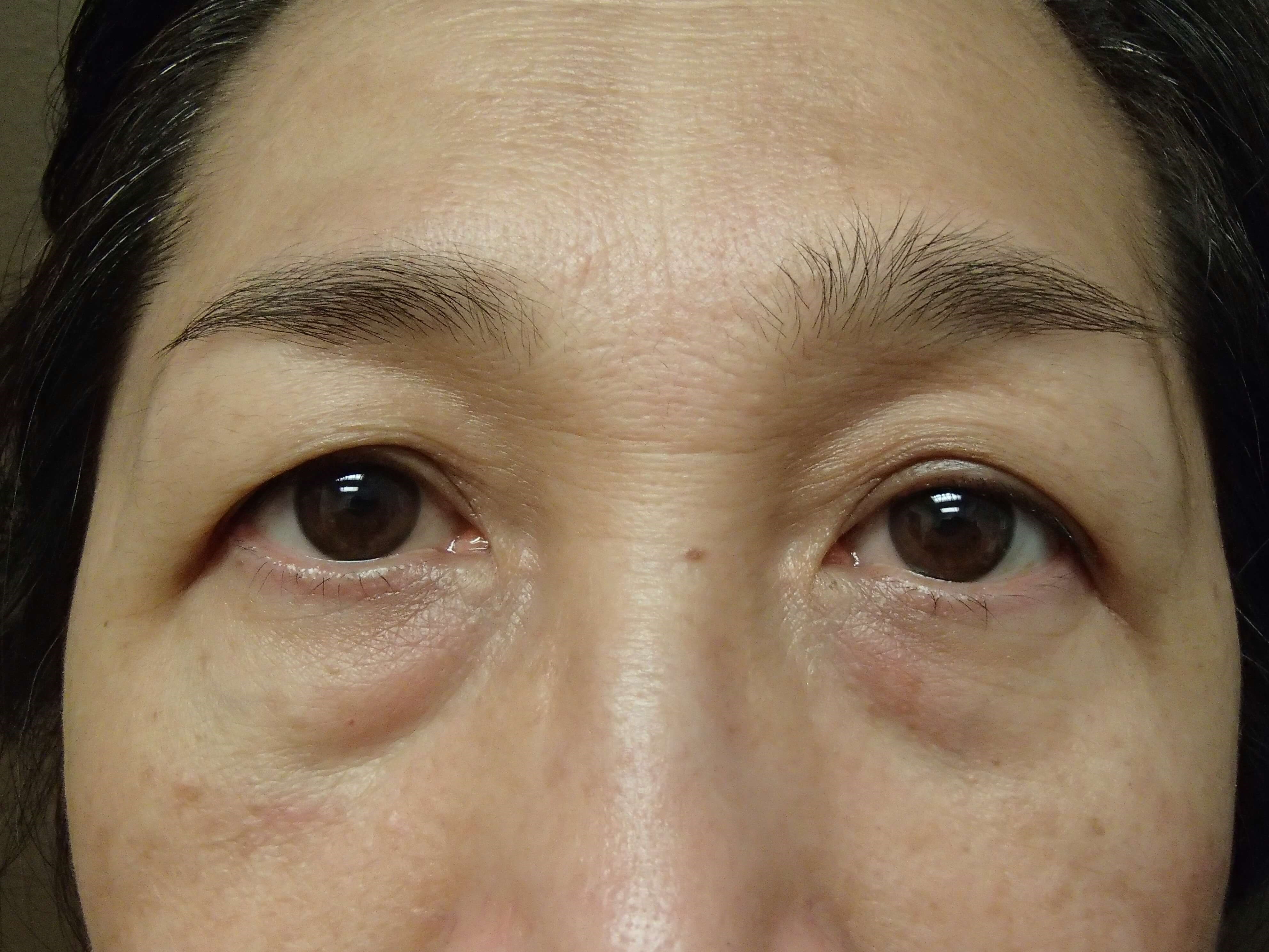 Asian Eyelid Lift Before