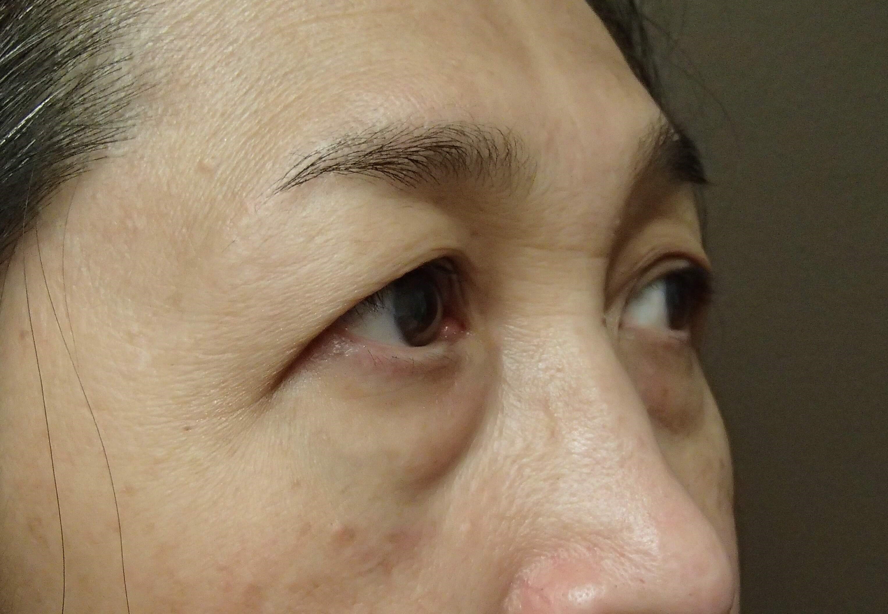 Asian Eyelid Lift Before