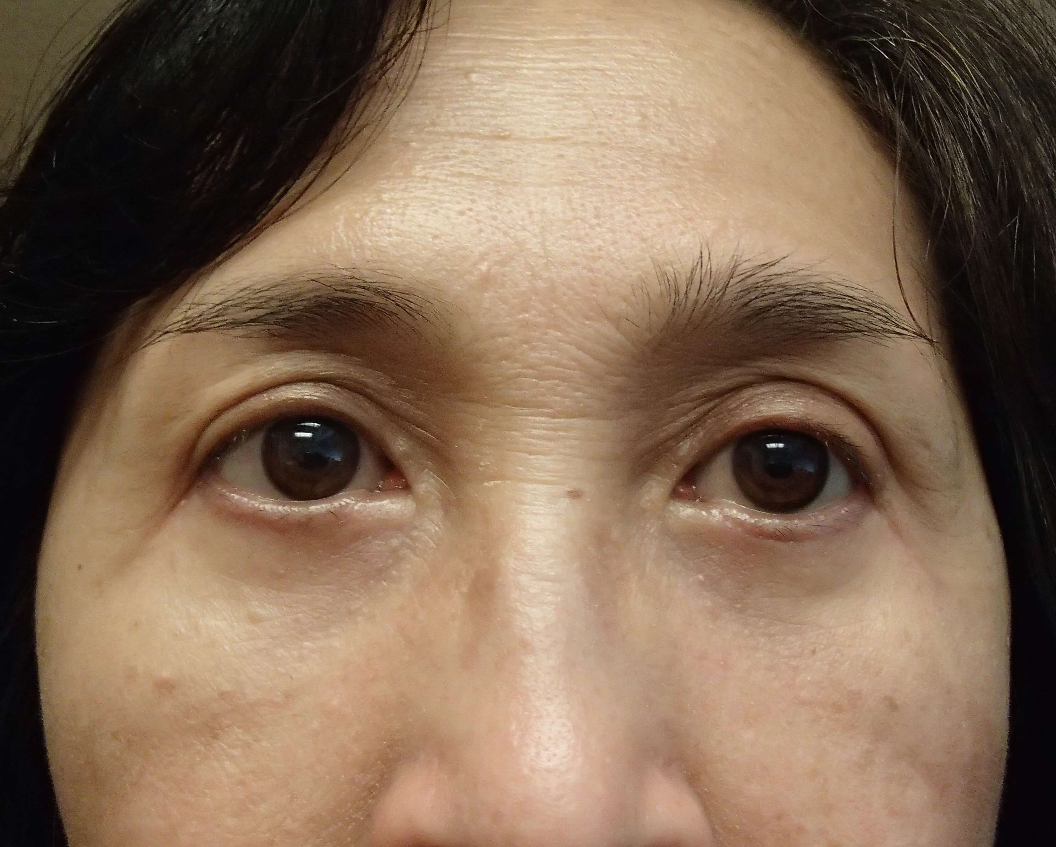 Asian Eyelid Lift After