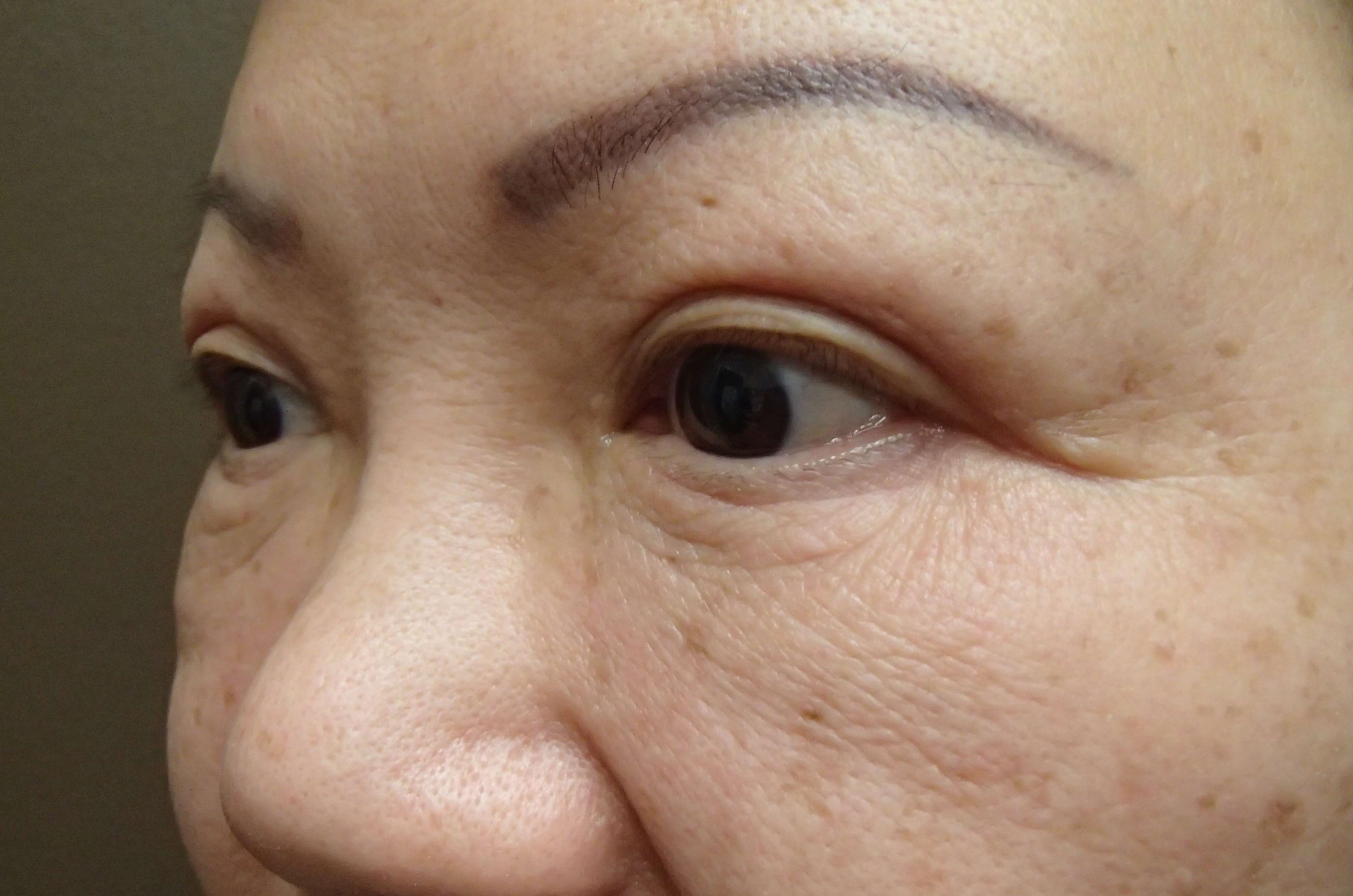 Asian Eyelid Lift After