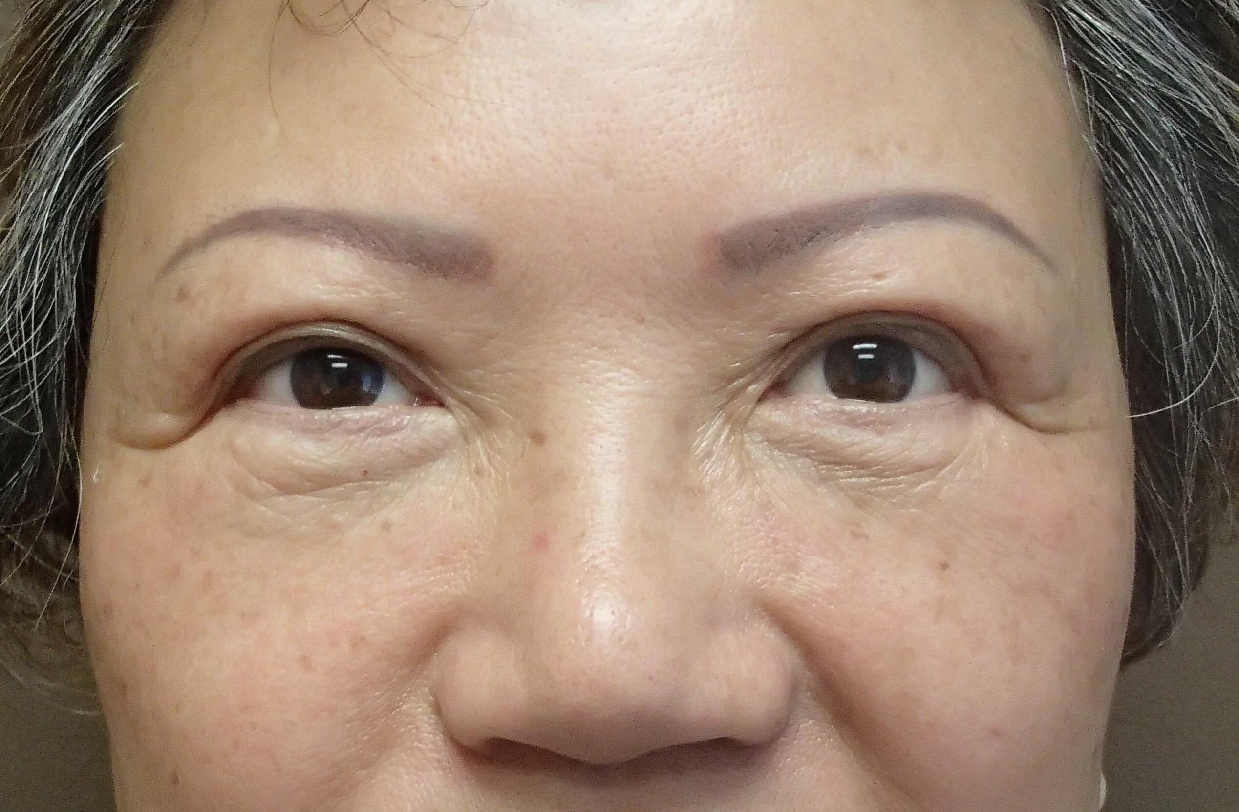 Asian Eyelid Lift After