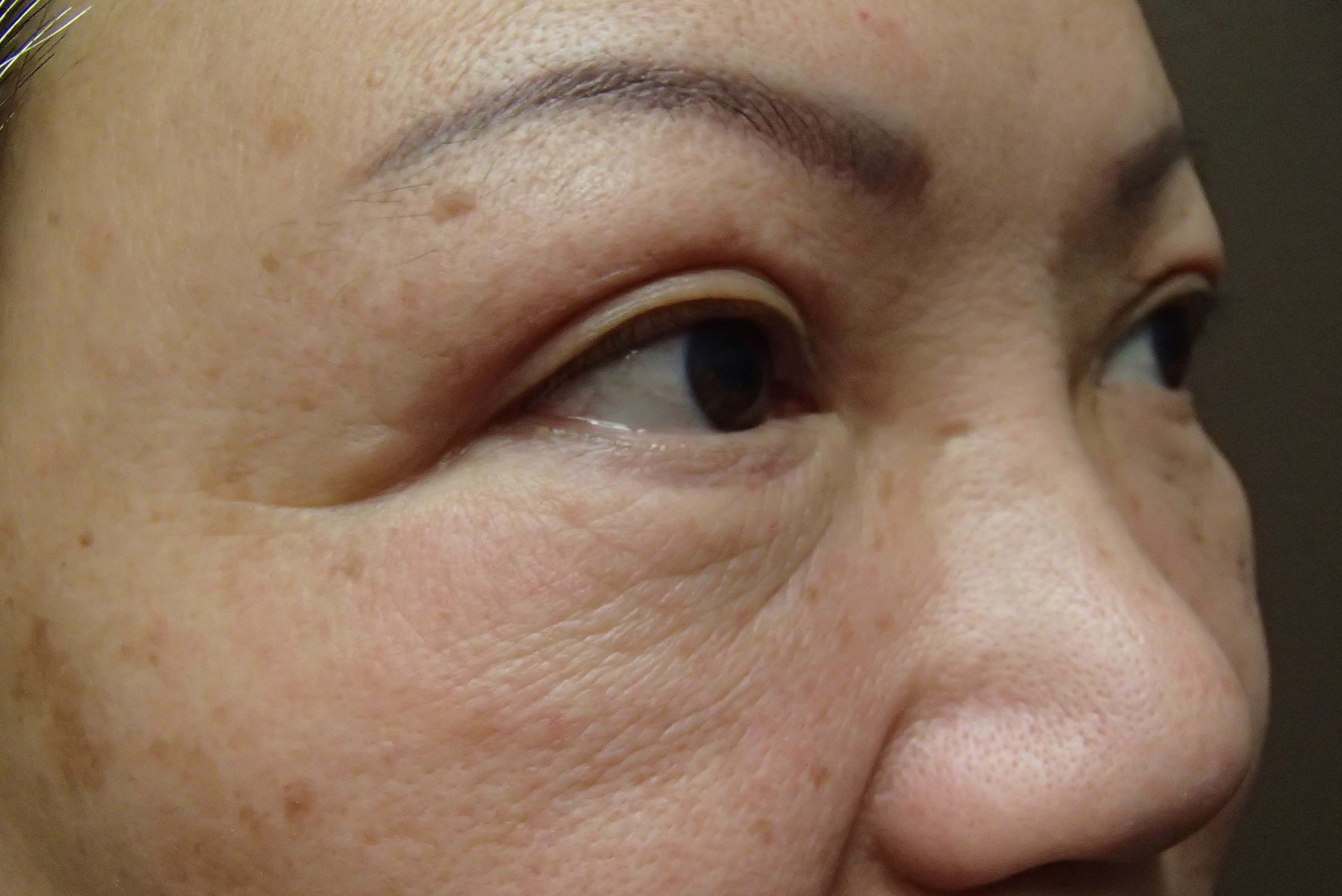 Asian Eyelid Lift After