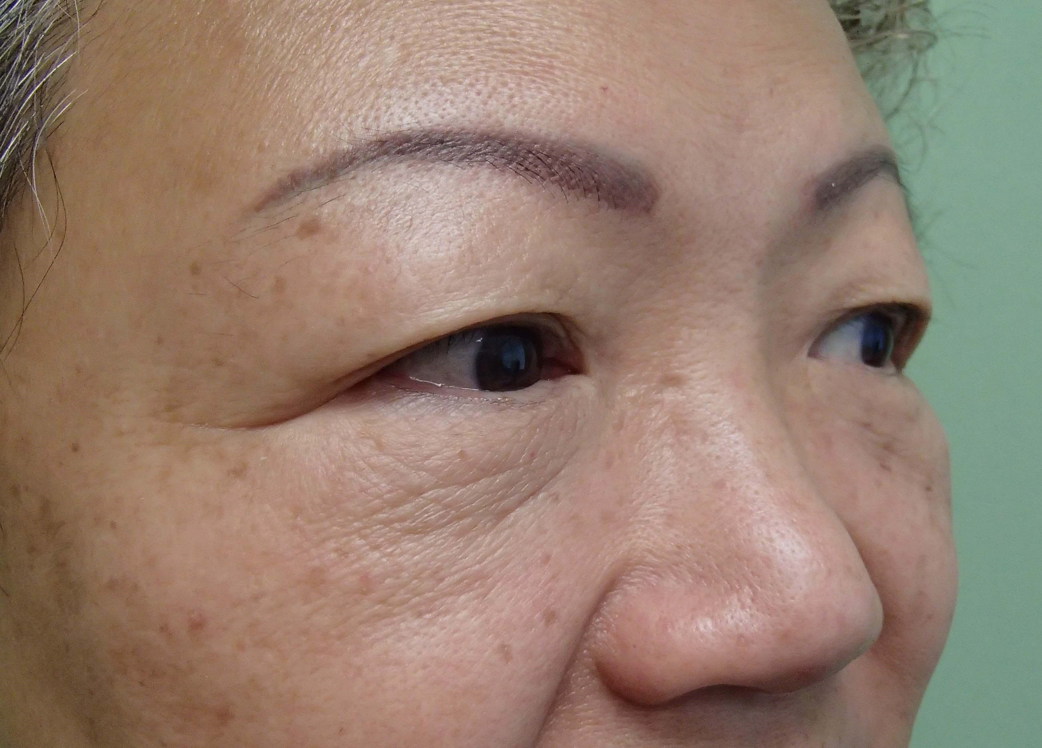 Asian Eyelid Lift Before
